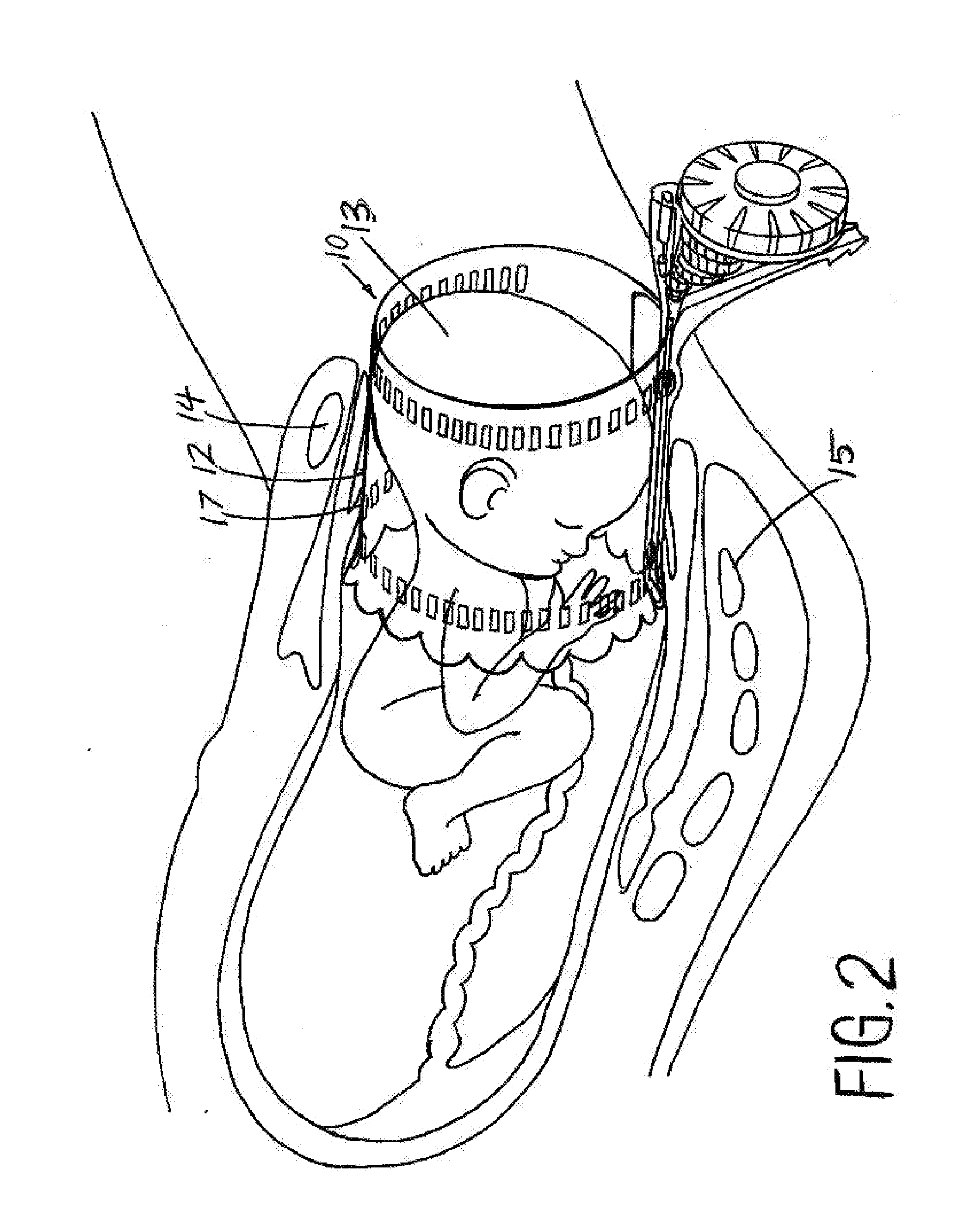 Childbirth labor reduction device