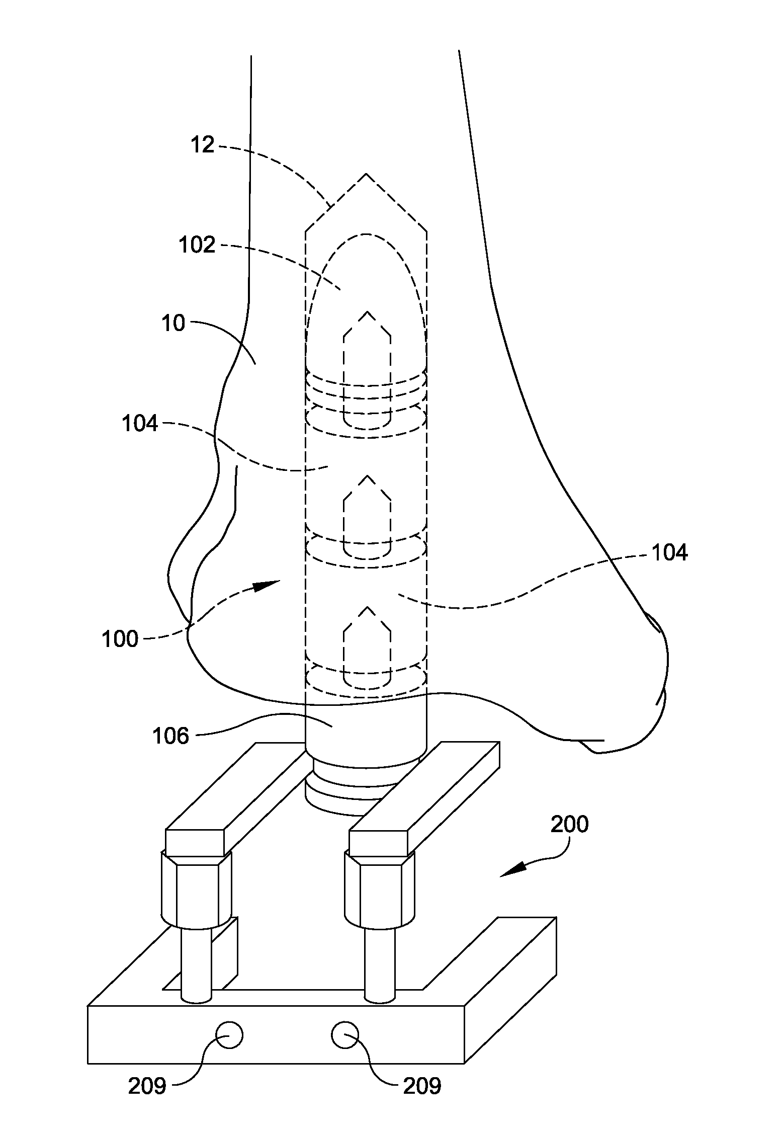 Intramedullary ankle technique and system