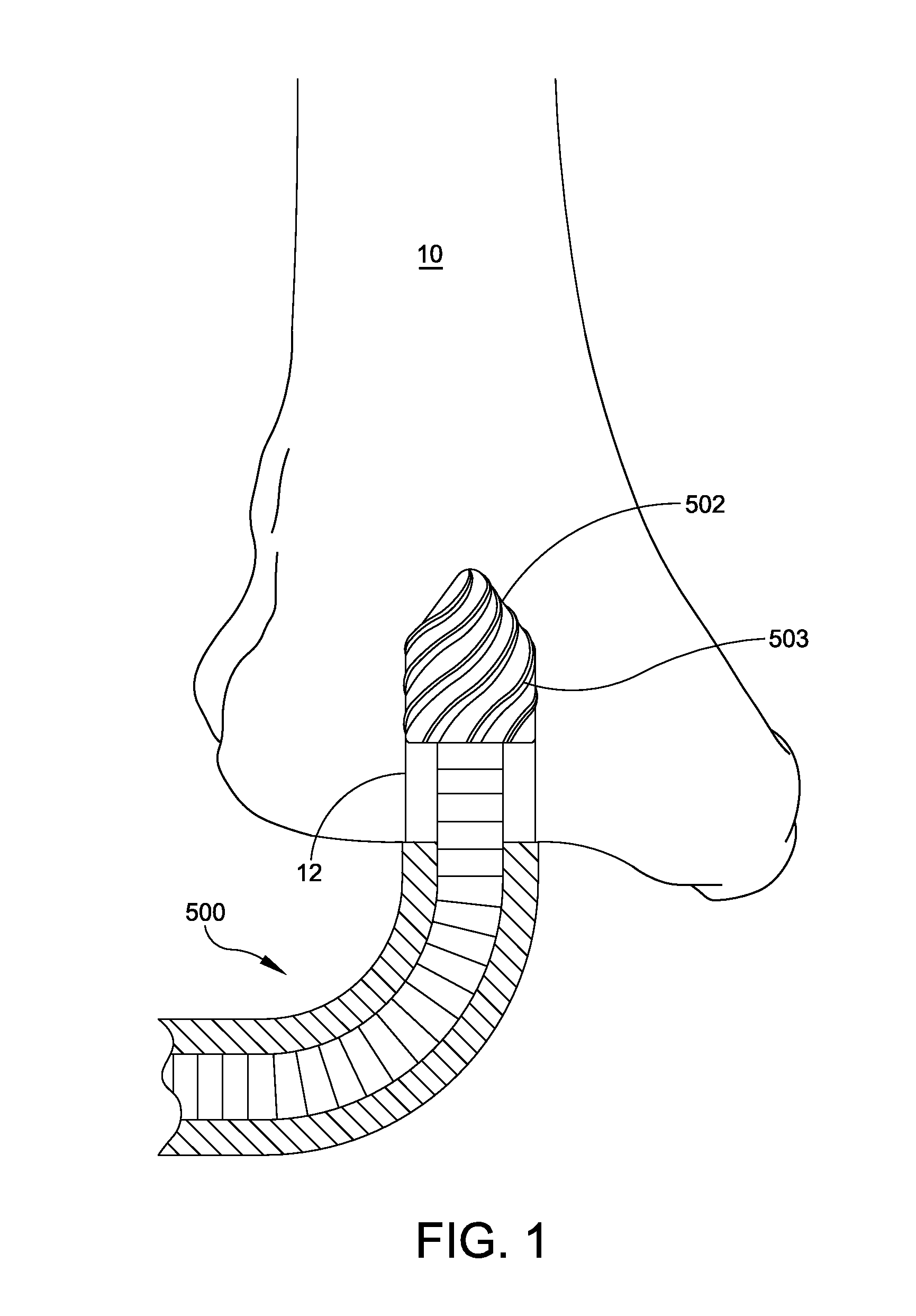 Intramedullary ankle technique and system