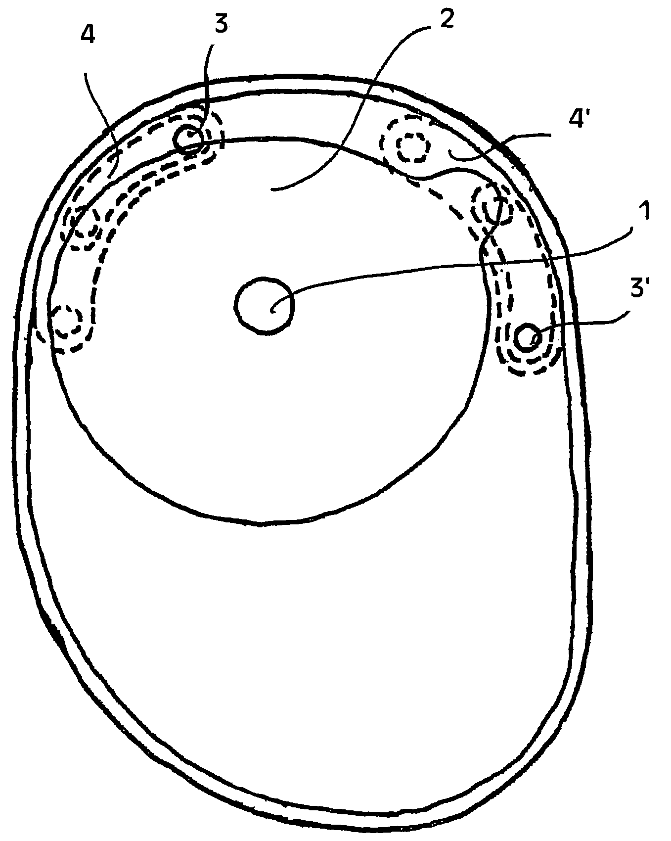 Ostomy appliance with multiple openings for preventing filter input blockage