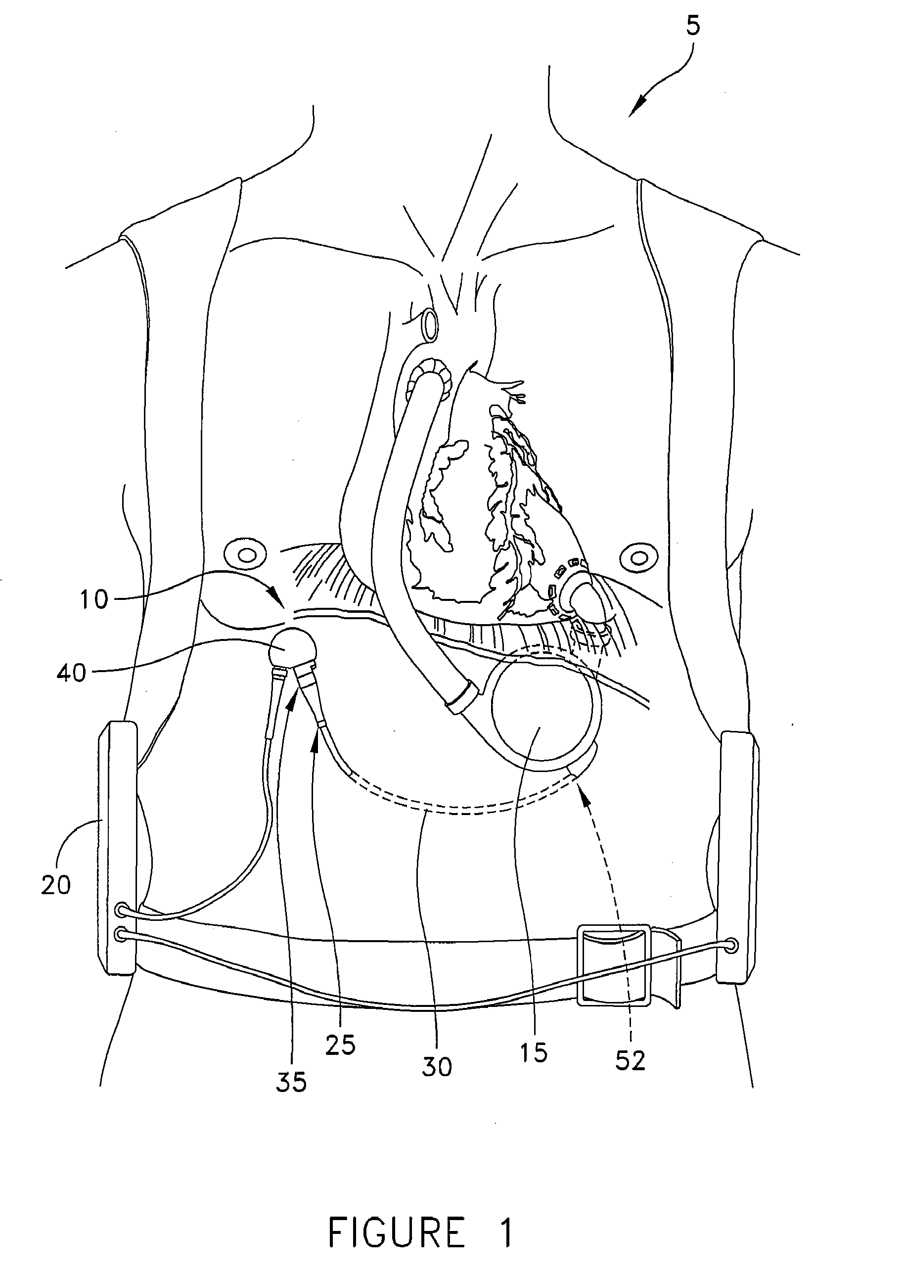 Implantable vad with replaceable percutaneous cable