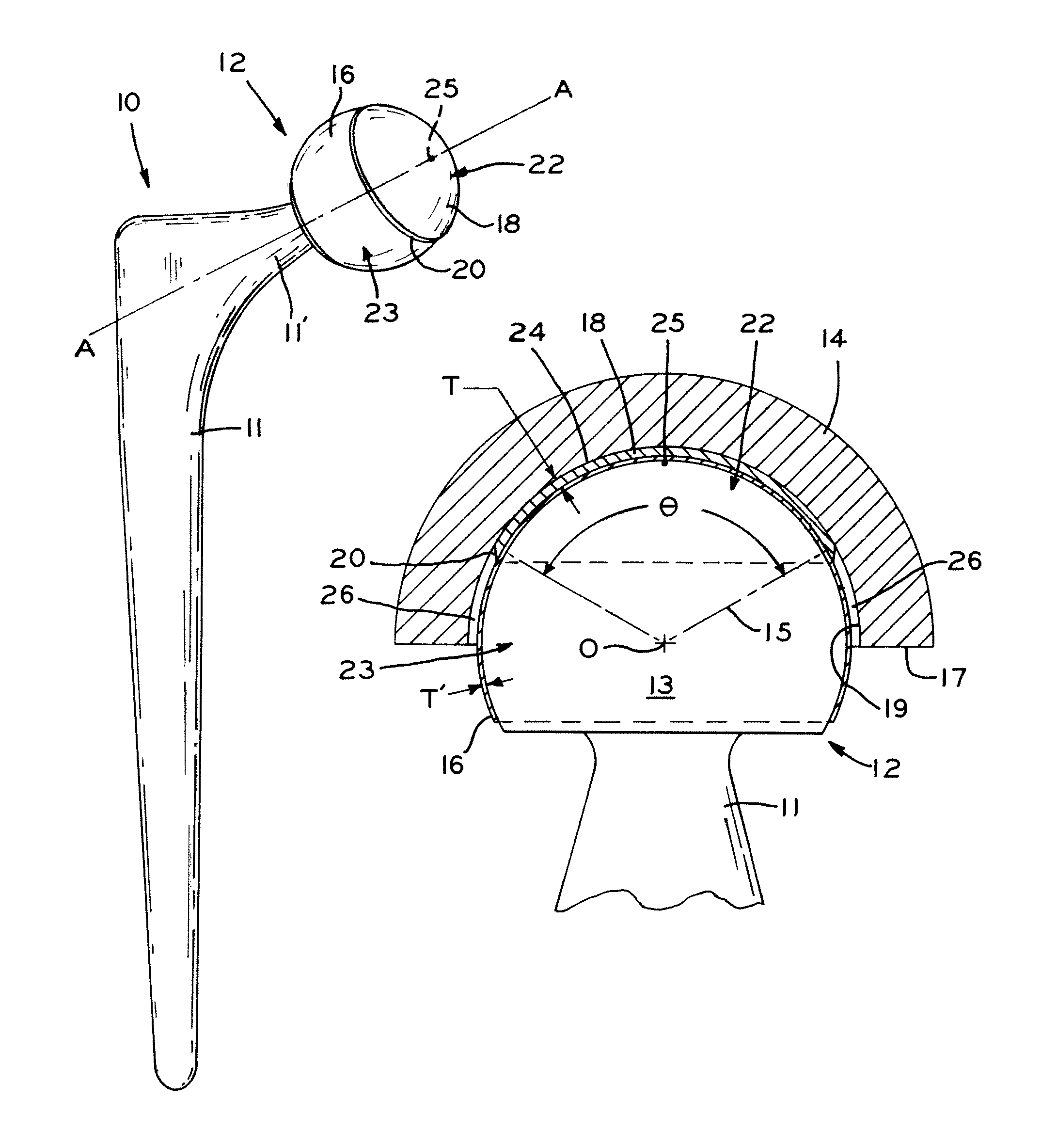 Bi-material prosthesis component