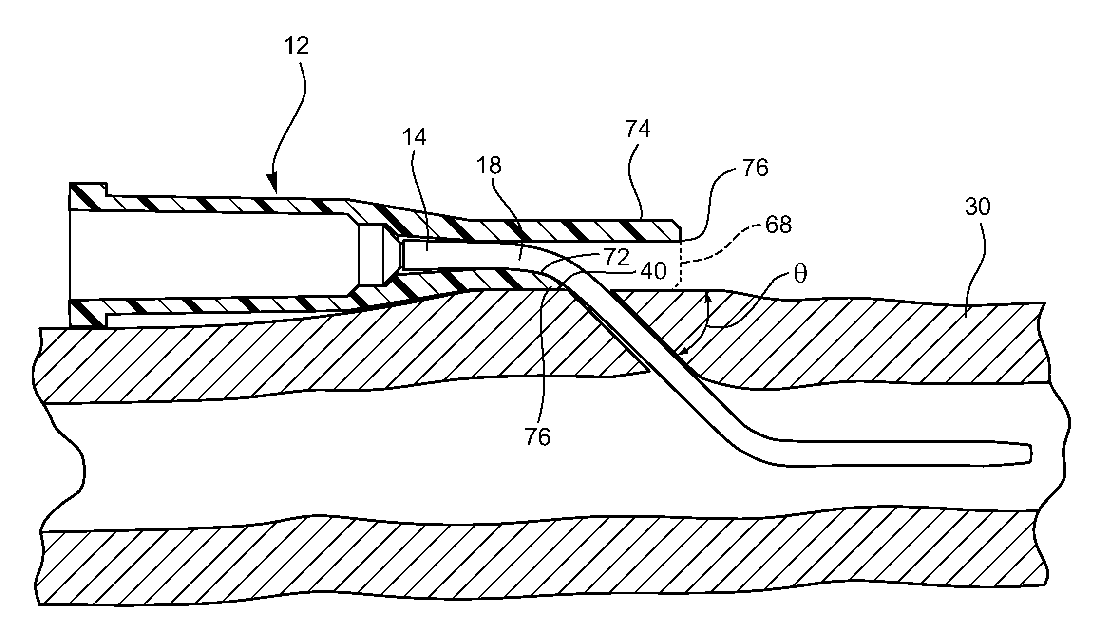 Occlusion resistant catheters