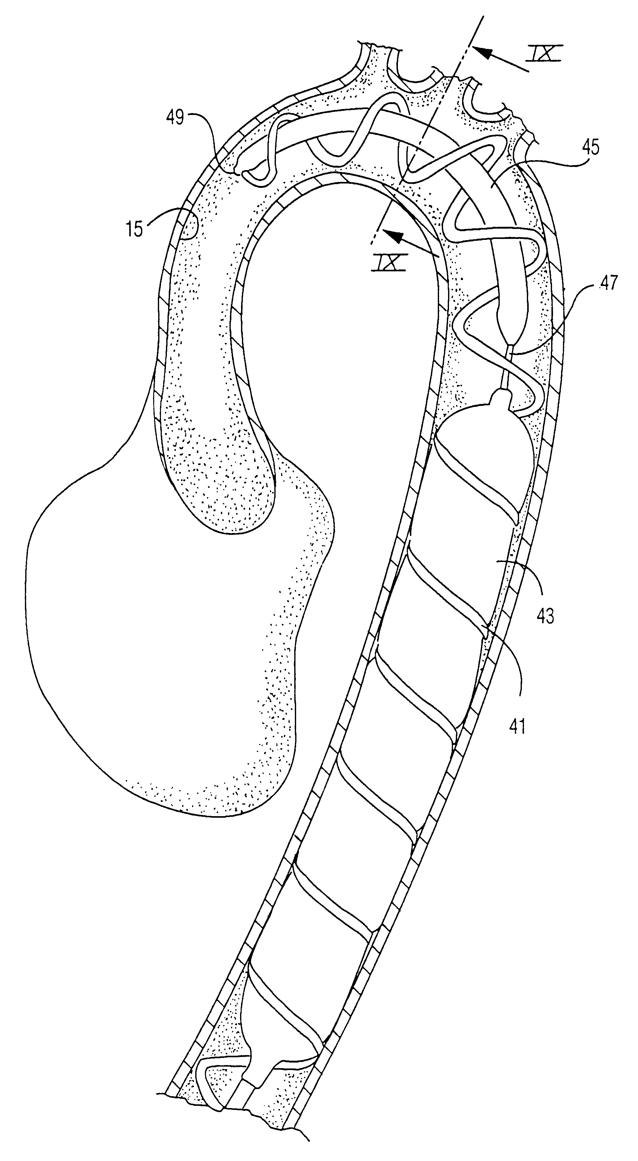 Removable left ventricular assist device with an aortic support apparatus