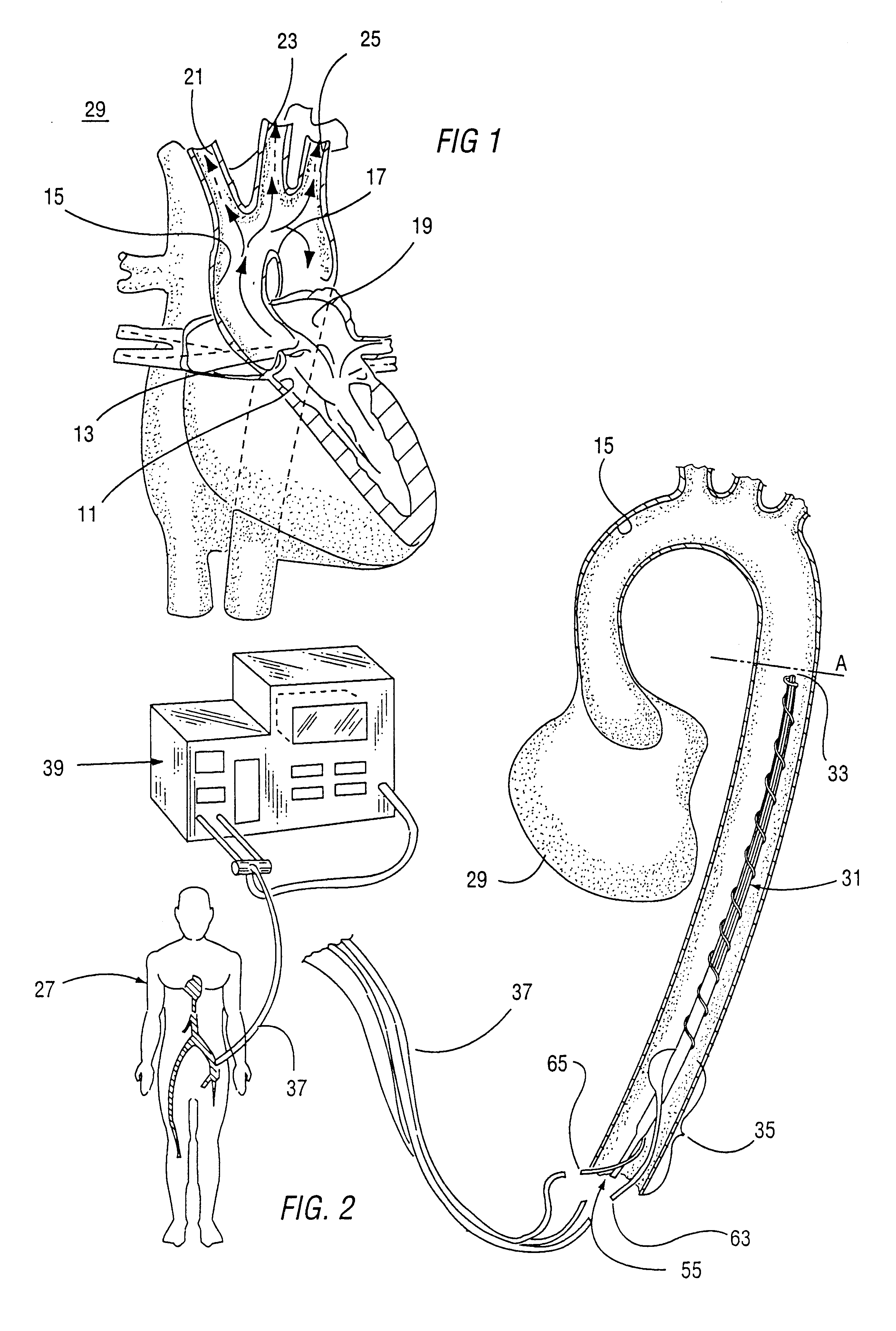 Removable left ventricular assist device with an aortic support apparatus