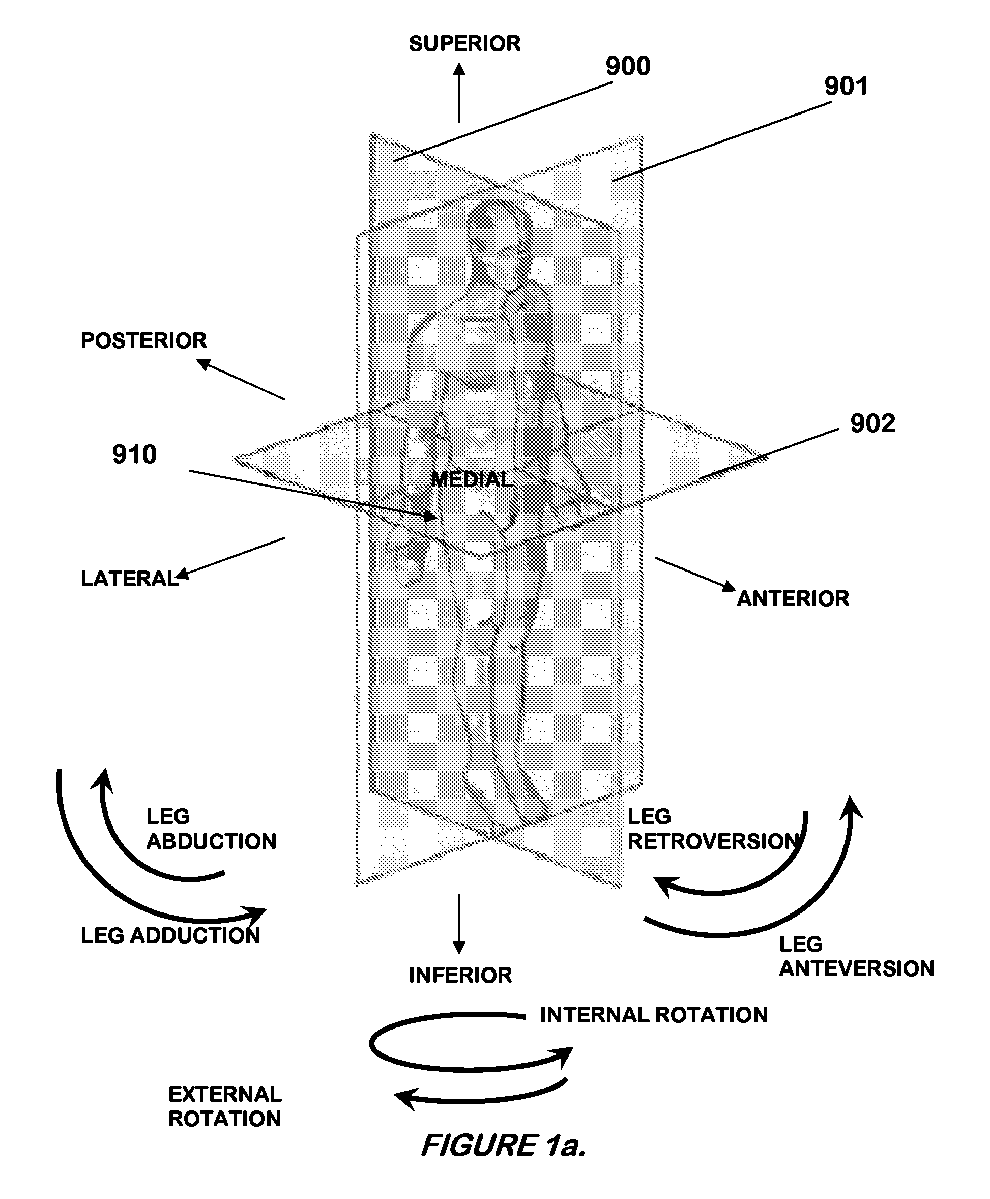 System of orienting femoral head for acetabular prosthesis alignment