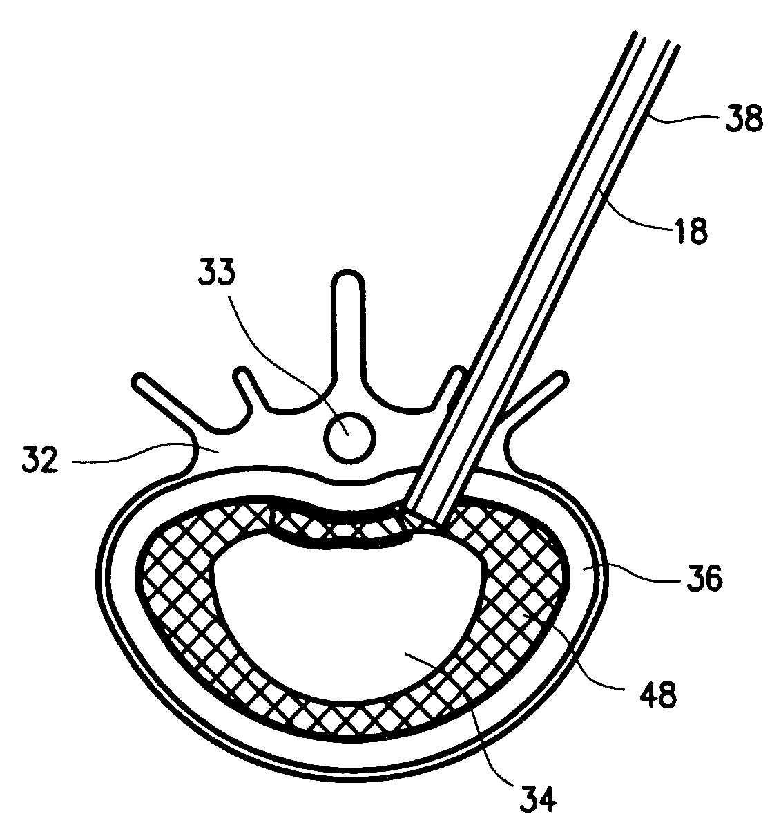 Mechanical apparatus and method for artificial disc replacement