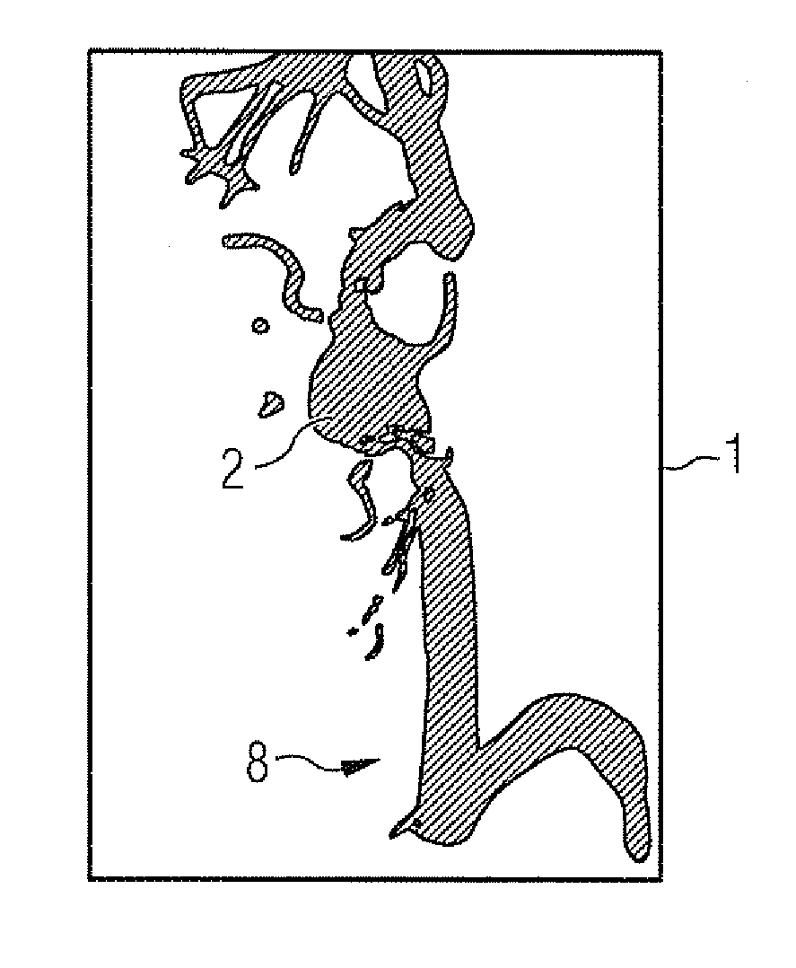 Method for post-processing a three-dimensional image data set of vessel structure