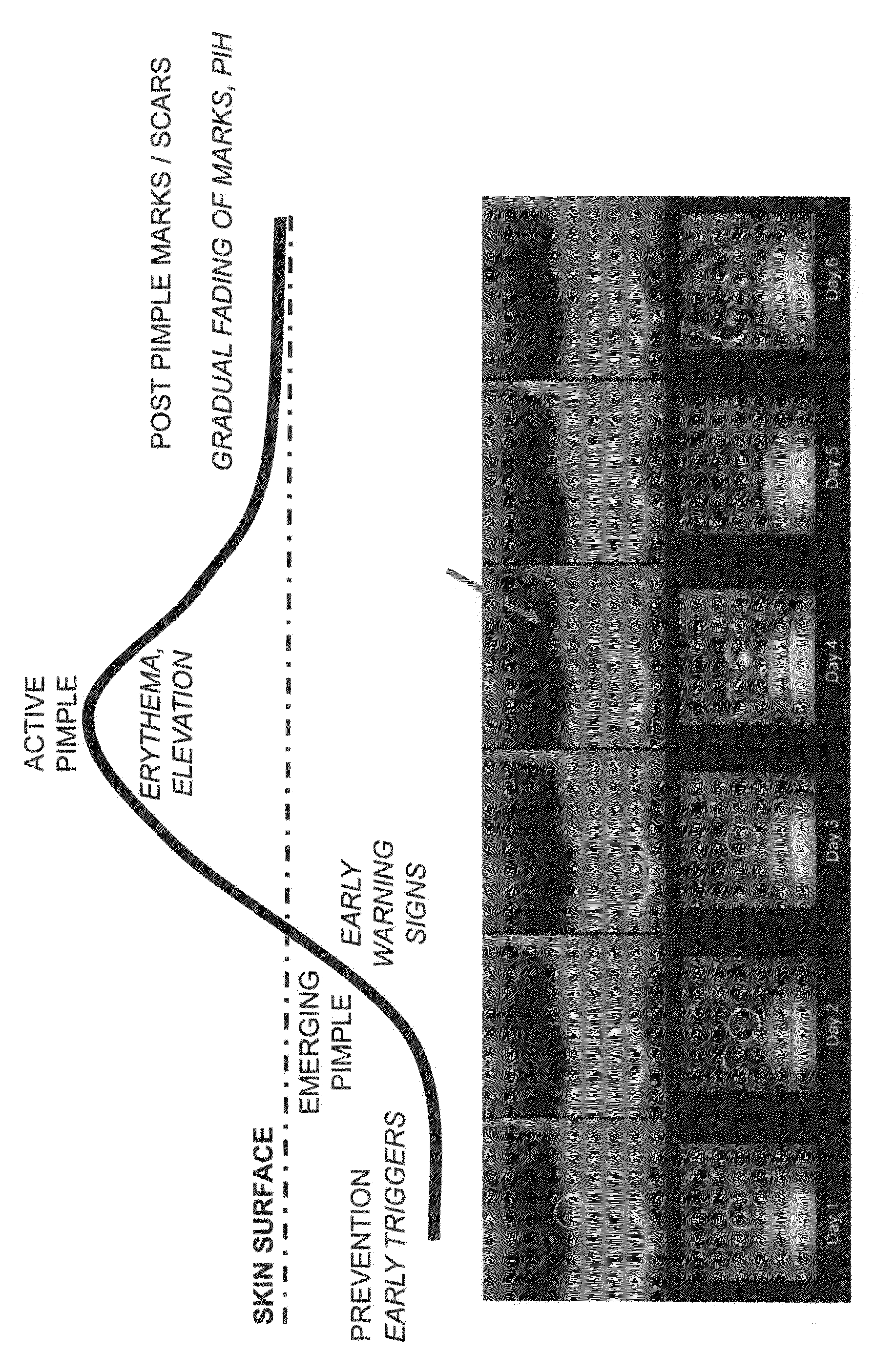 Method for demonstrating pre-emergent pimples