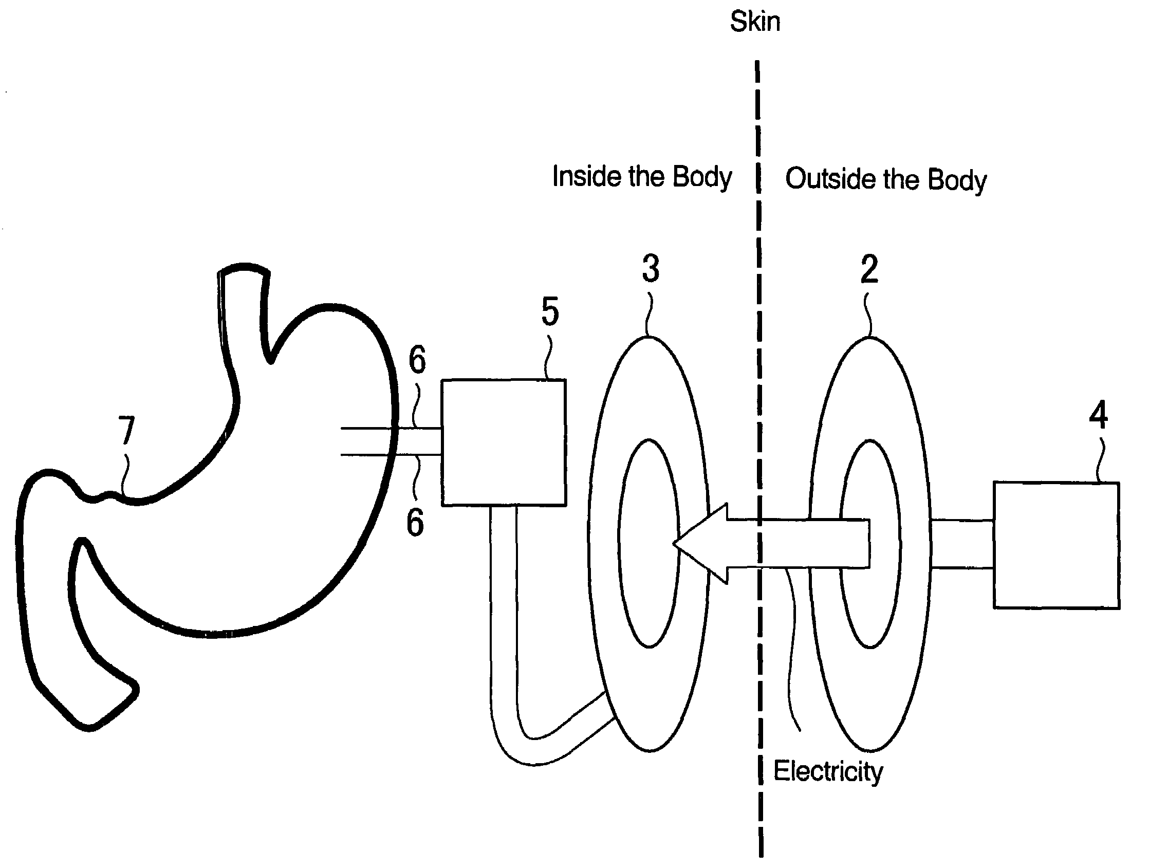 Device for electrically stimulating stomach