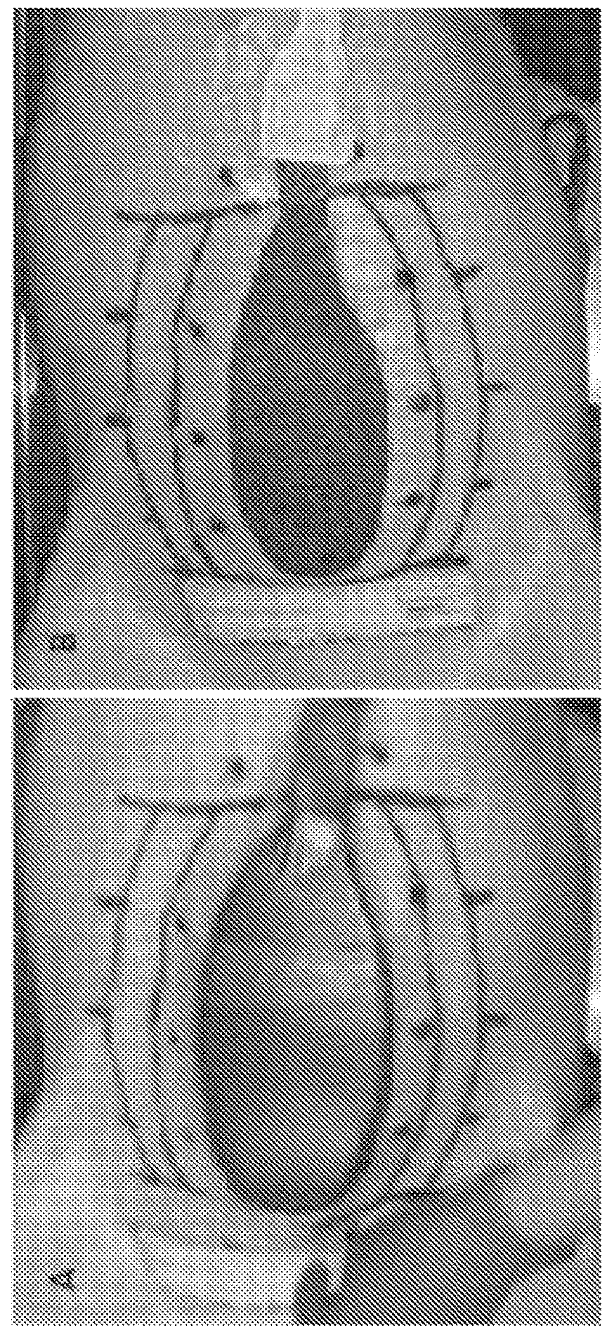 Negative pressure wound closure device