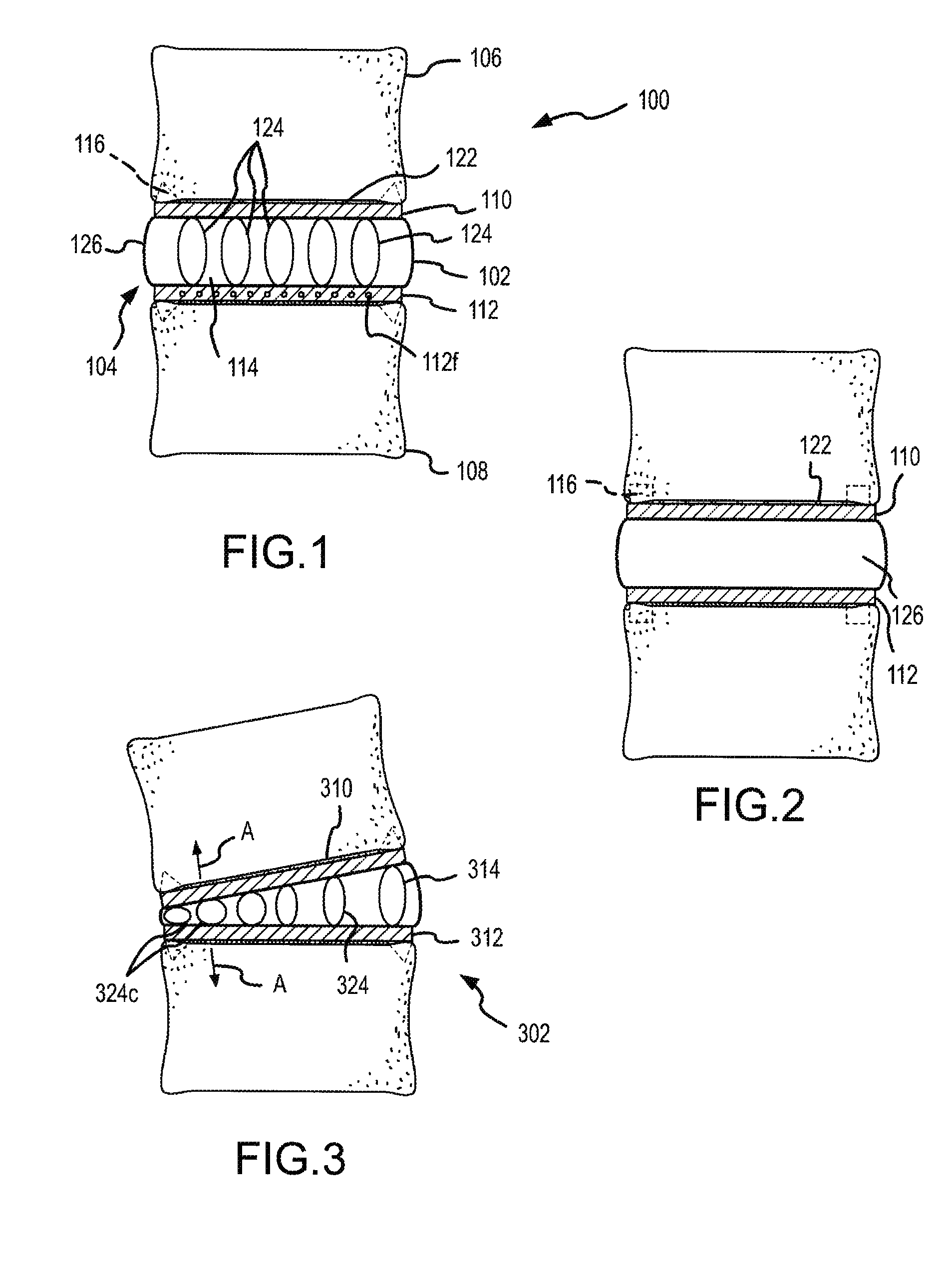 Corrective artificial disc