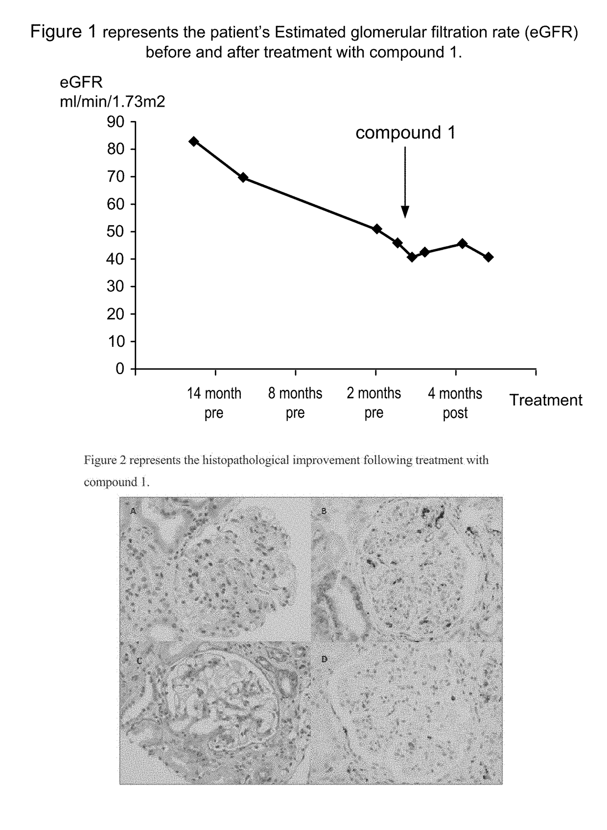 Method of treating c3 glomerulopathy