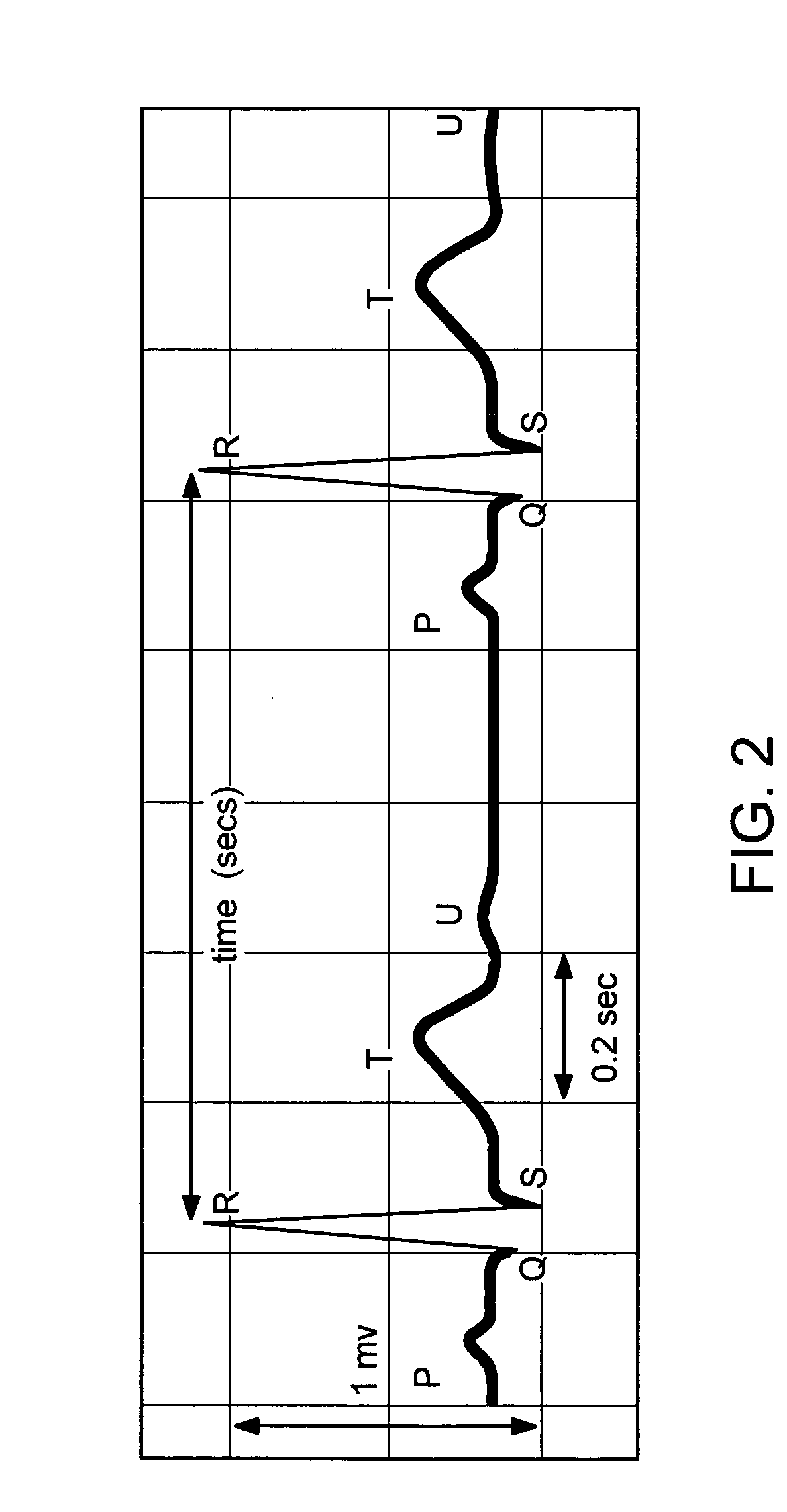 Atrial fibrillation detection method and apparatus