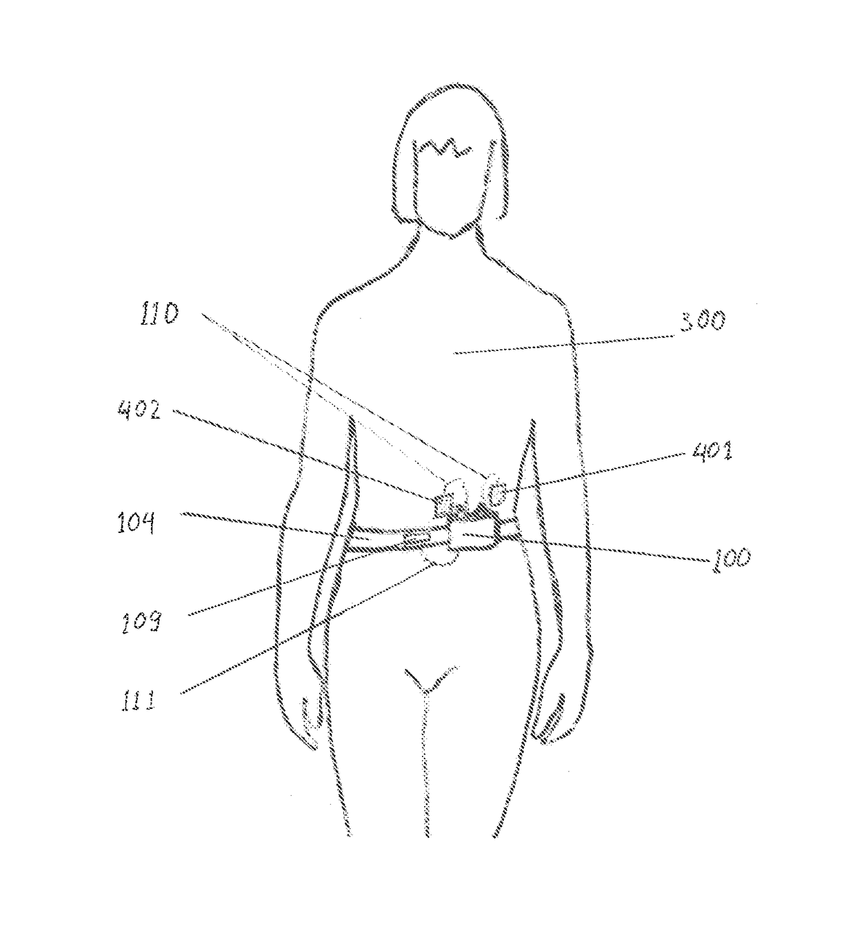 Non-invasive device and method for treating gastro esophageal reflux disease (GERD) and the digestive system