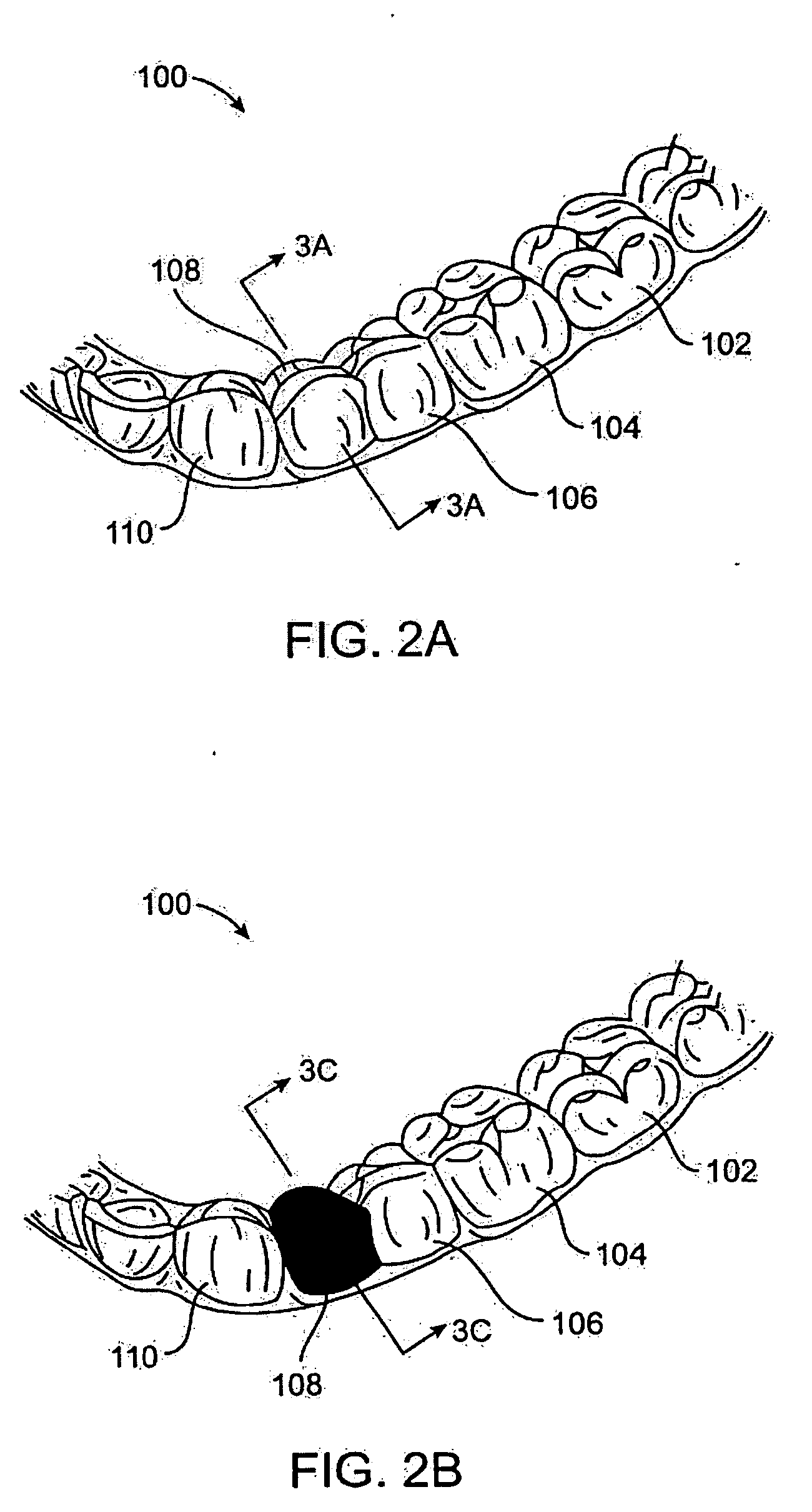 Method and kits for forming pontics in polymeric shell aligners