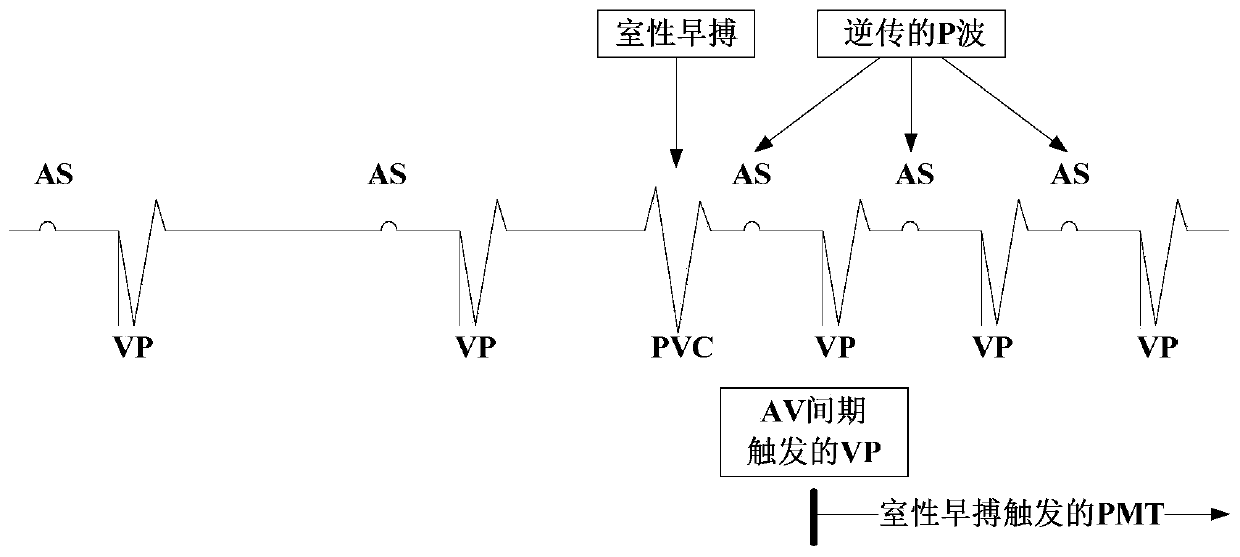 PMT inducement detection and prevention method, storage medium, and pacemaker system and device