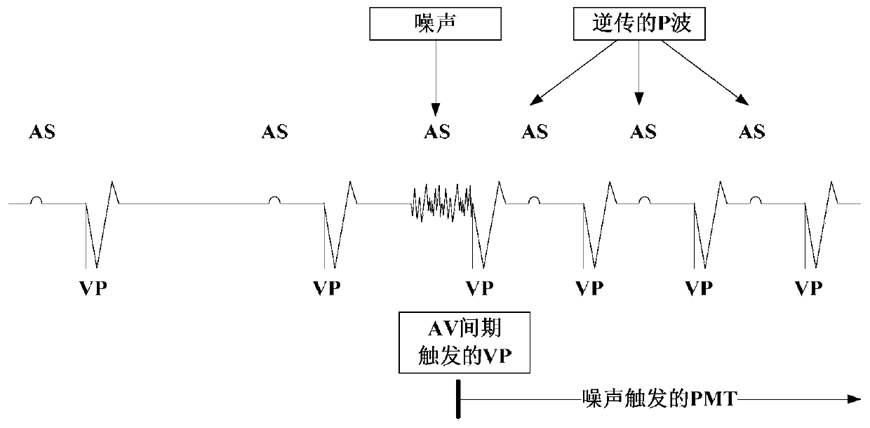 PMT inducement detection and prevention method, storage medium, and pacemaker system and device