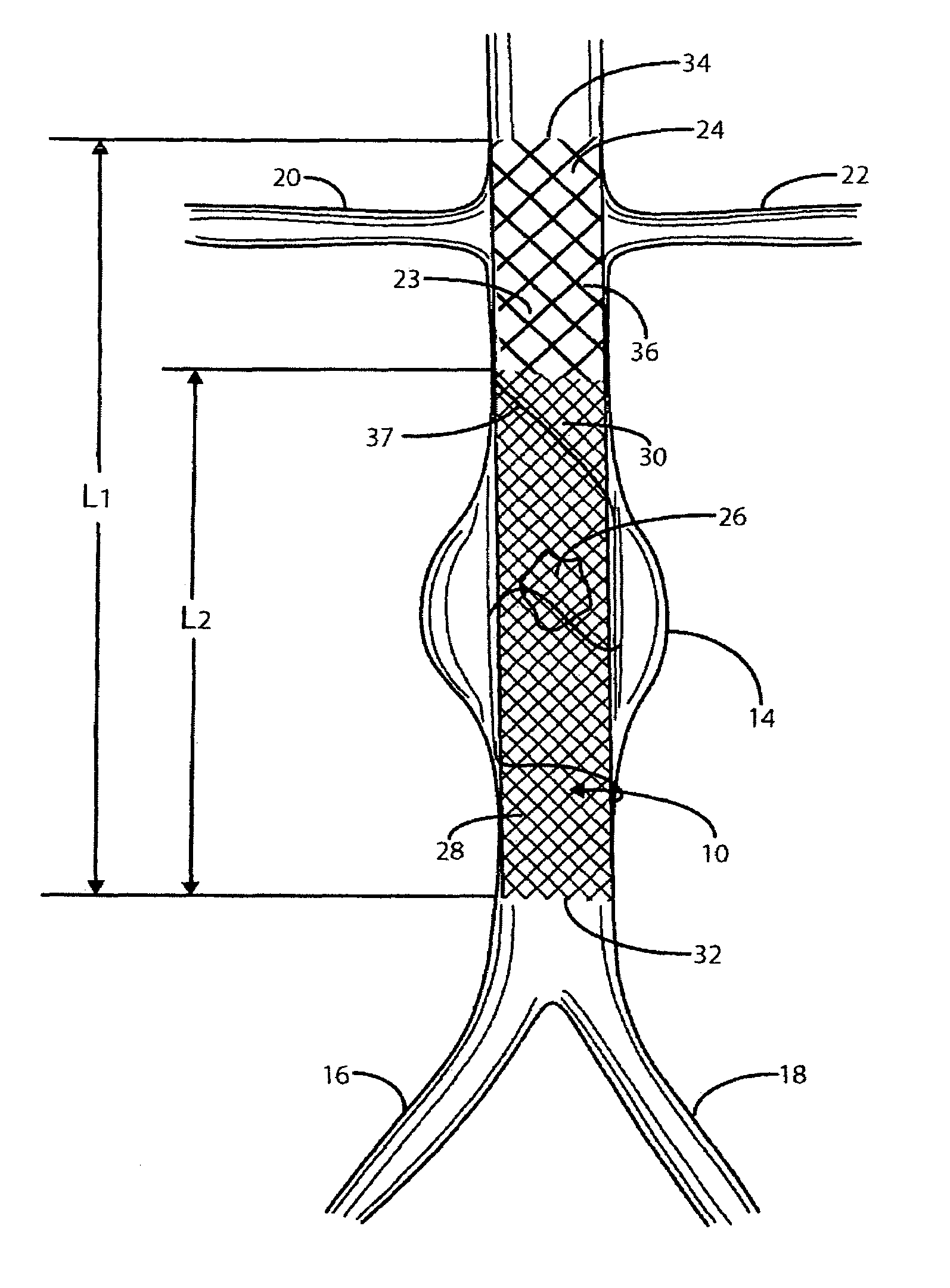 Intravascular deliverable stent for reinforcement of vascular abnormalities