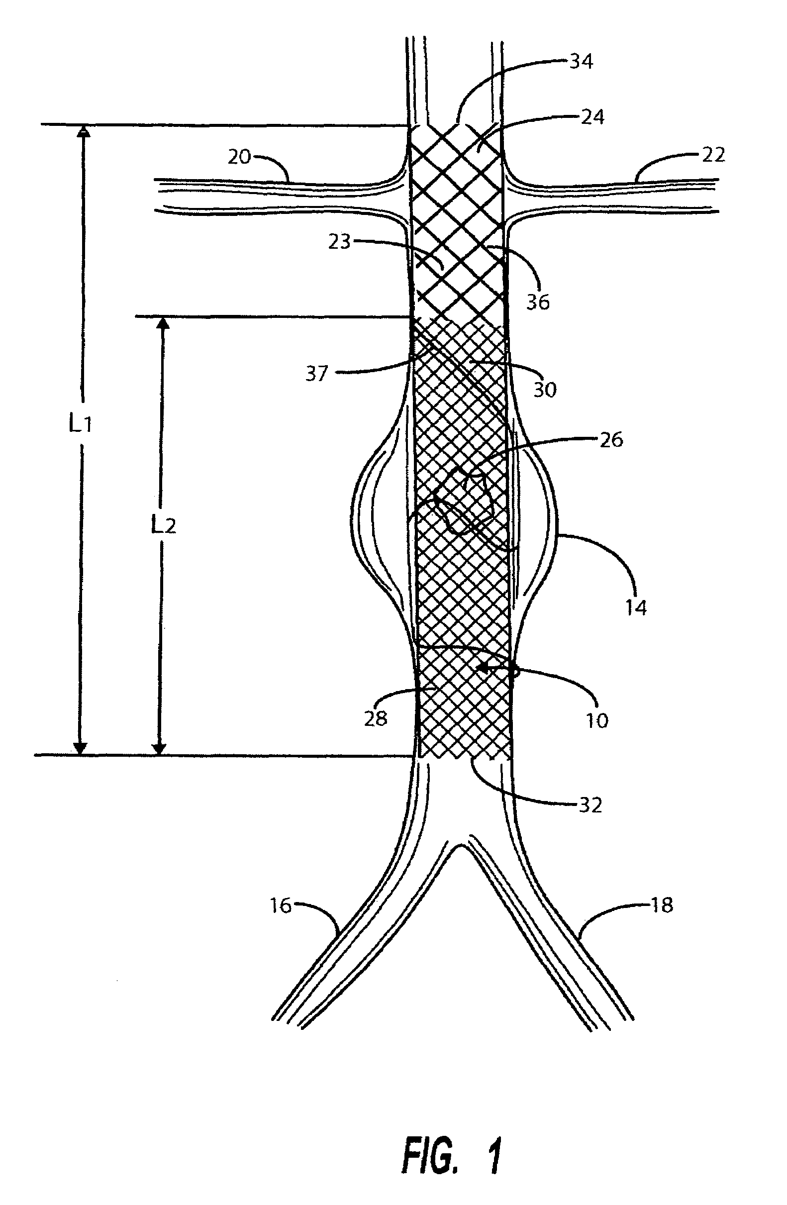 Intravascular deliverable stent for reinforcement of vascular abnormalities