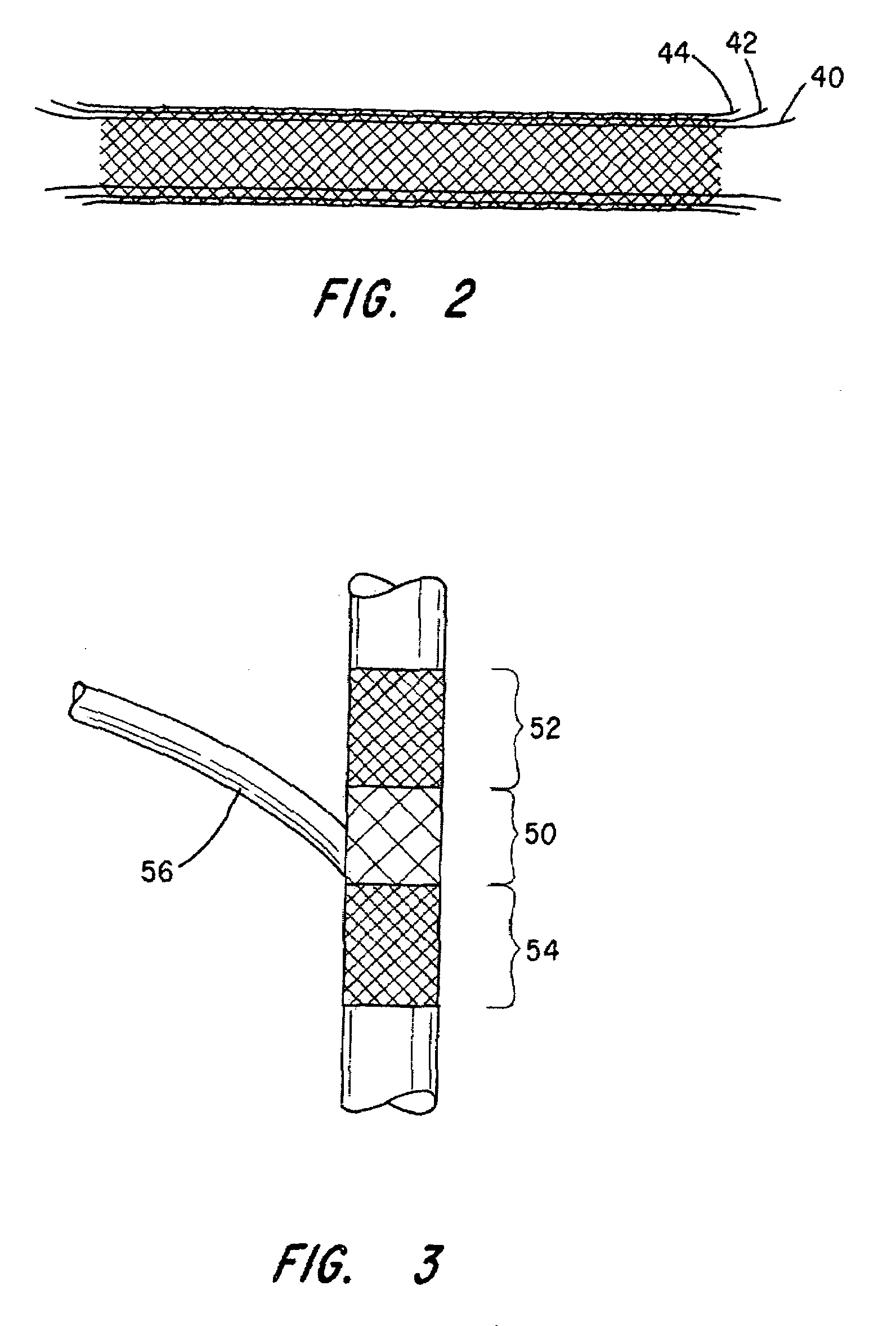 Intravascular deliverable stent for reinforcement of vascular abnormalities