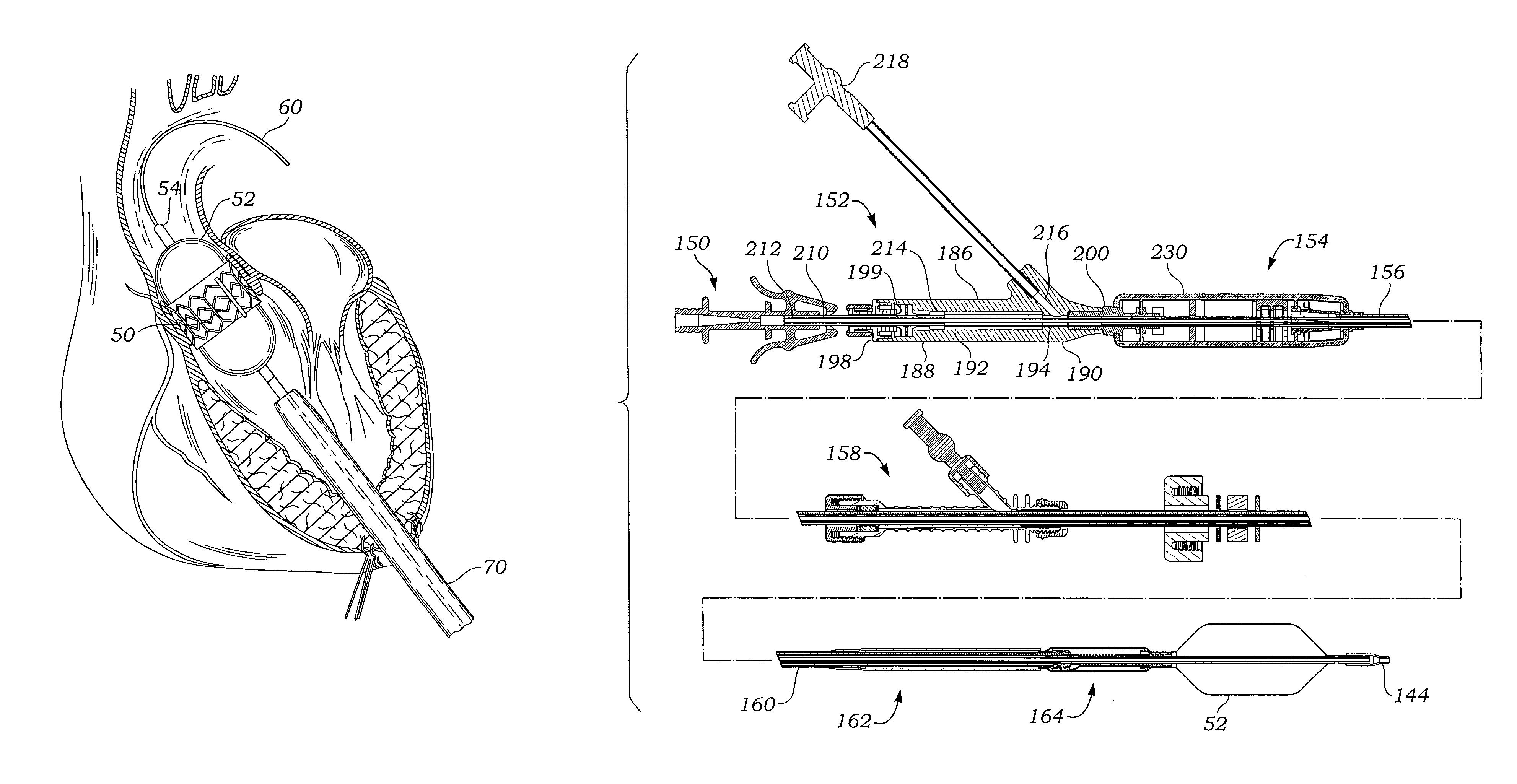 Transapical heart valve delivery system and method