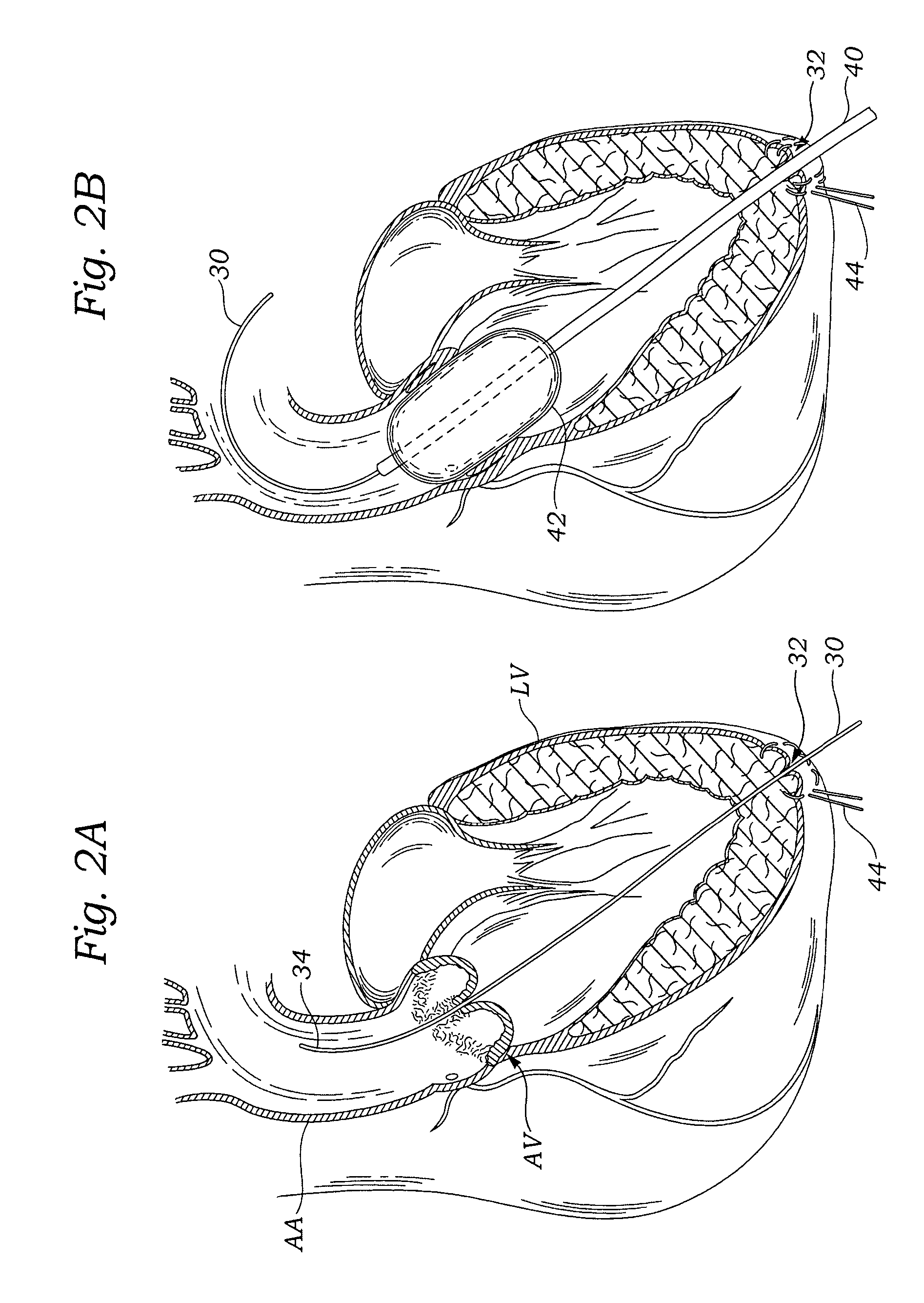 Transapical heart valve delivery system and method