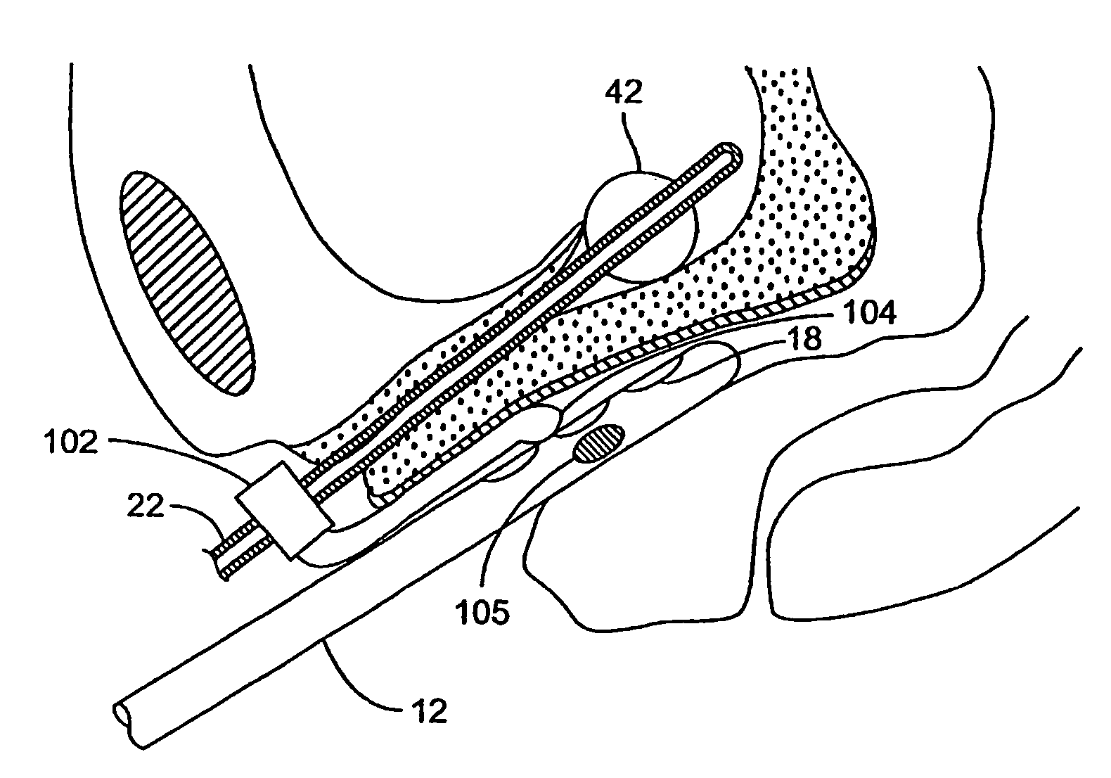 Incontinence treatment with urethral guide