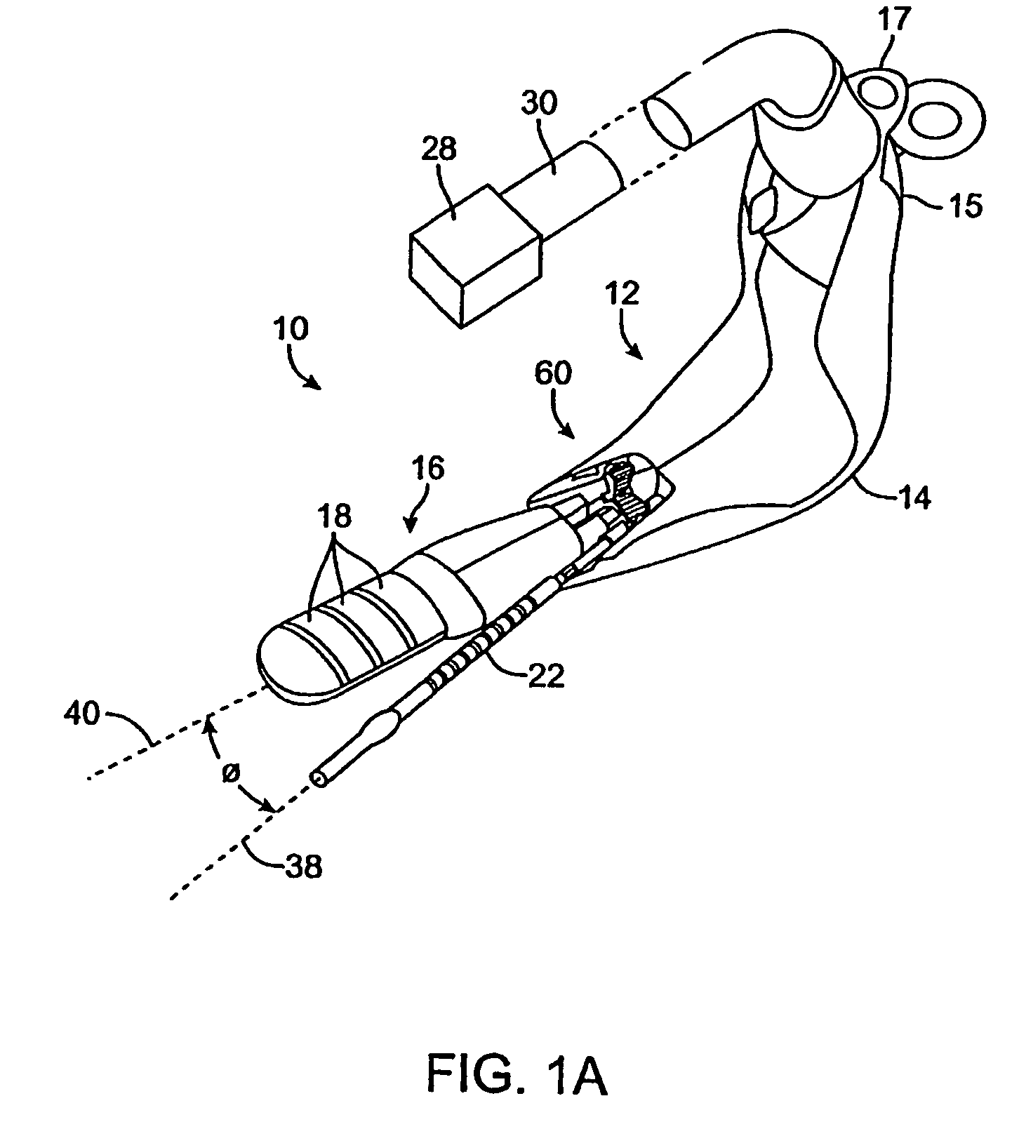 Incontinence treatment with urethral guide