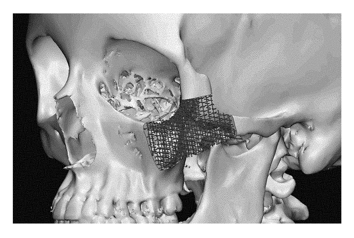 Osteoconductive and osteoinductive implant for augmentation, stabilization, or defect reconstruction