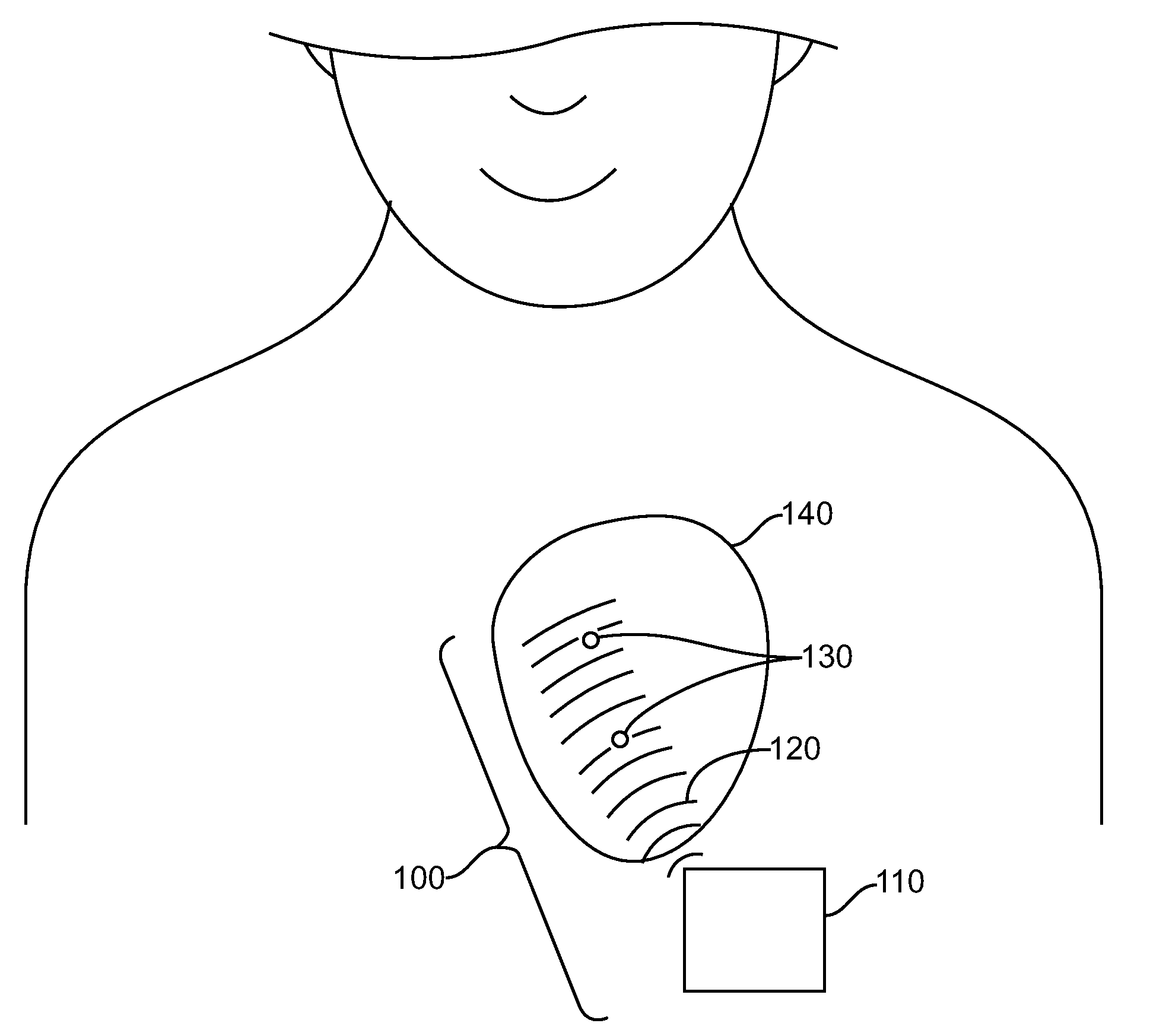 Operation and estimation of output voltage of wireless stimulators