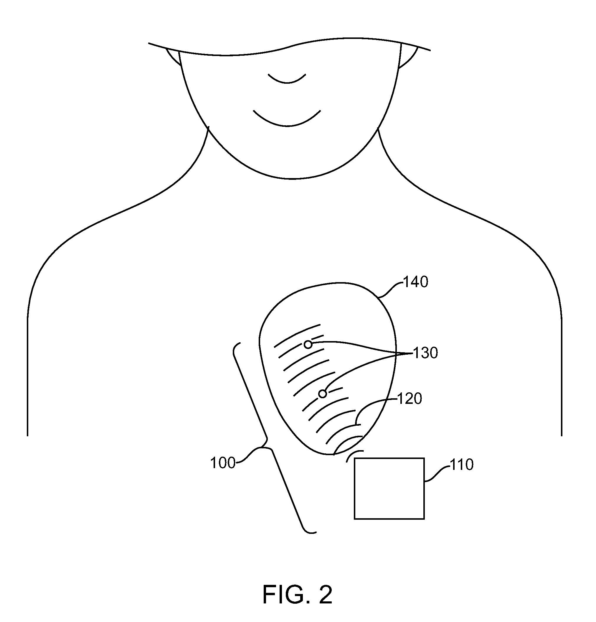 Operation and estimation of output voltage of wireless stimulators