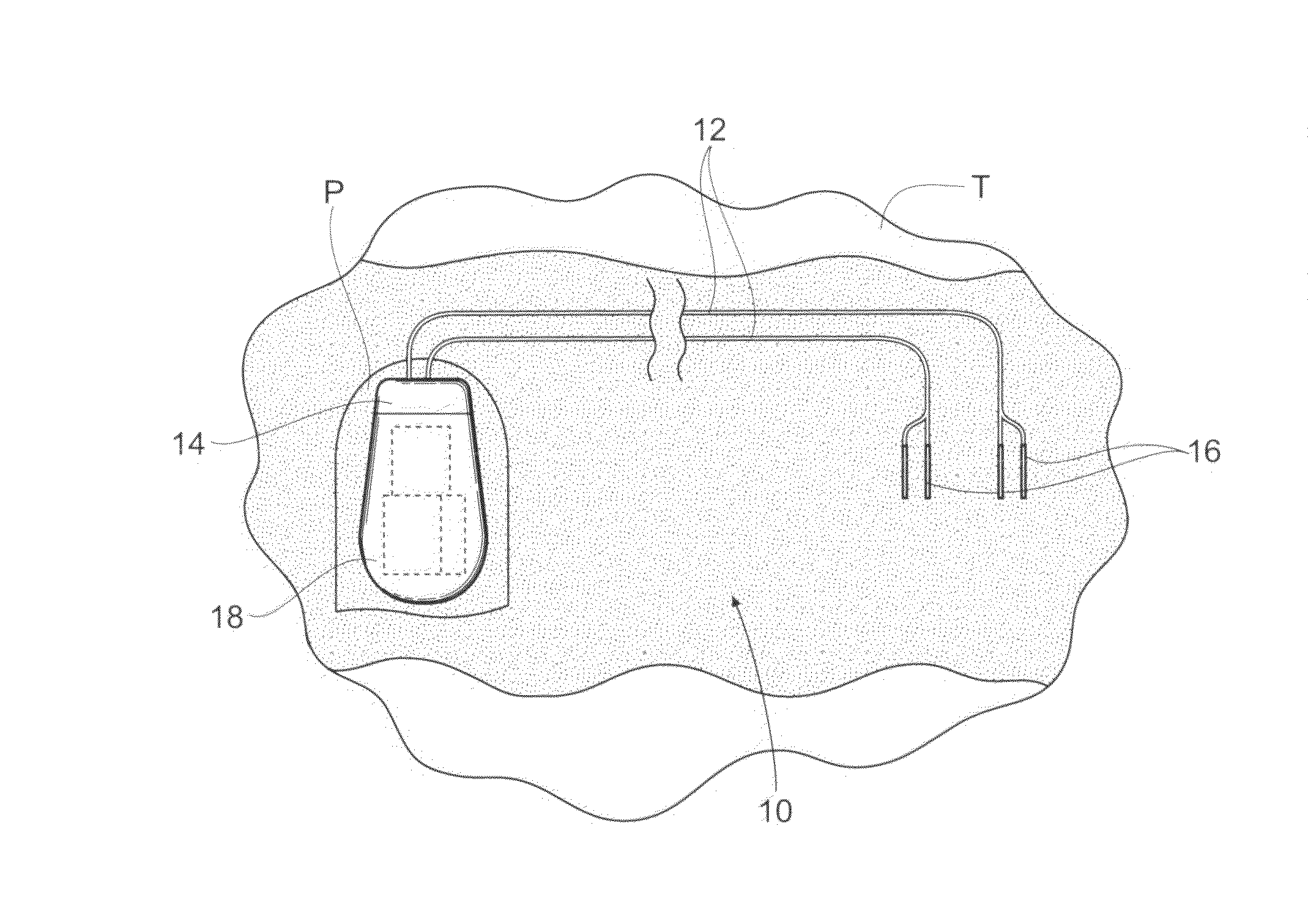 Implantable systems and methods for acquisition and processing of electrical signals for therapeutic and/or functional restoration purposes