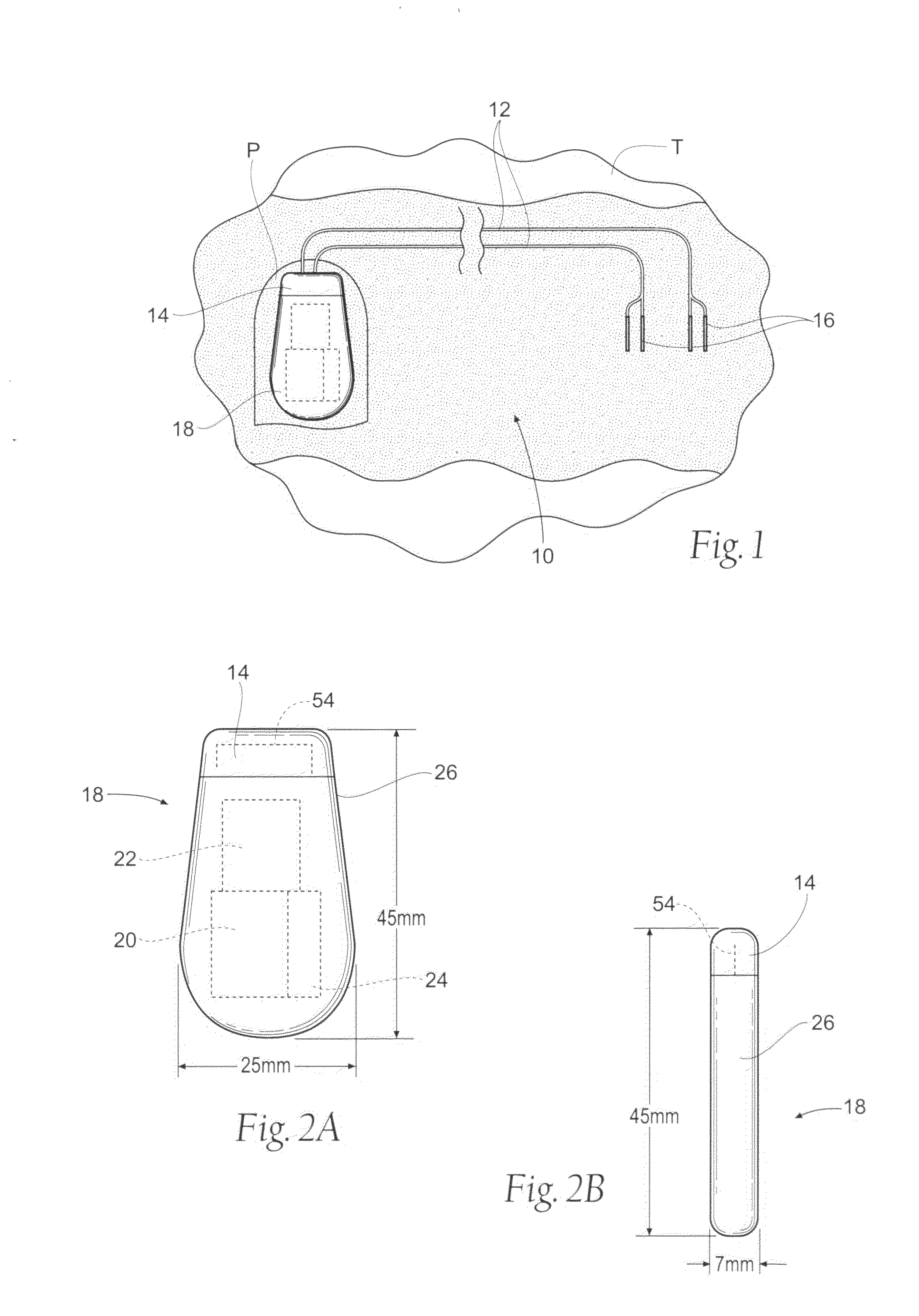 Implantable systems and methods for acquisition and processing of electrical signals for therapeutic and/or functional restoration purposes