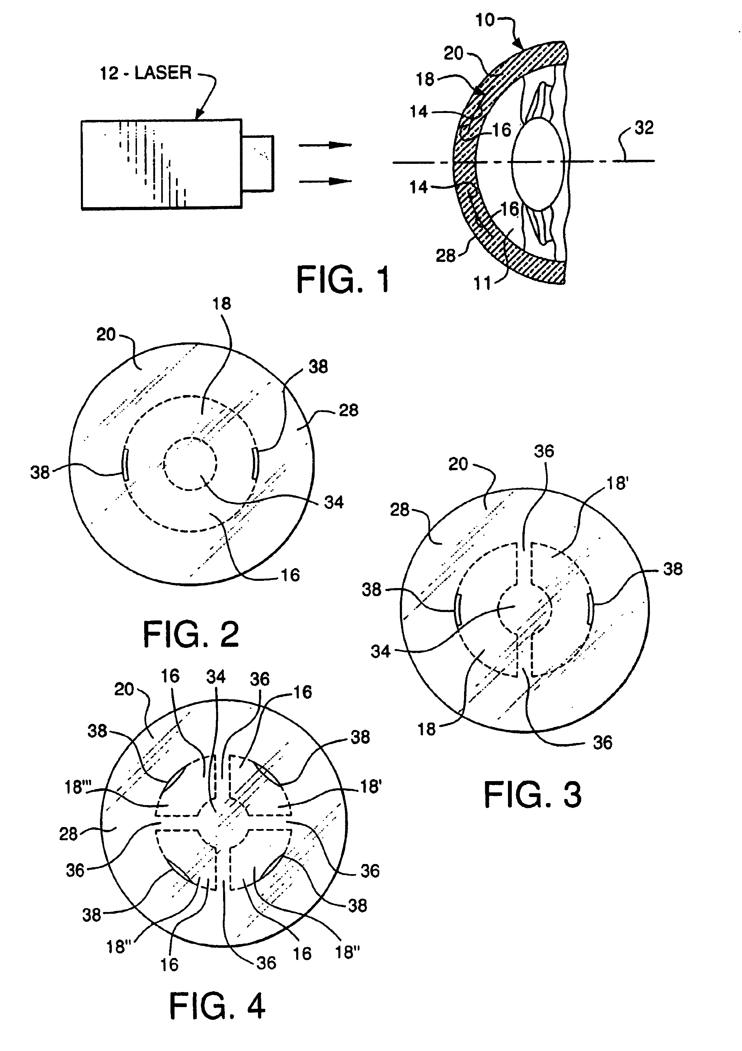 Adjustable ablatable inlay