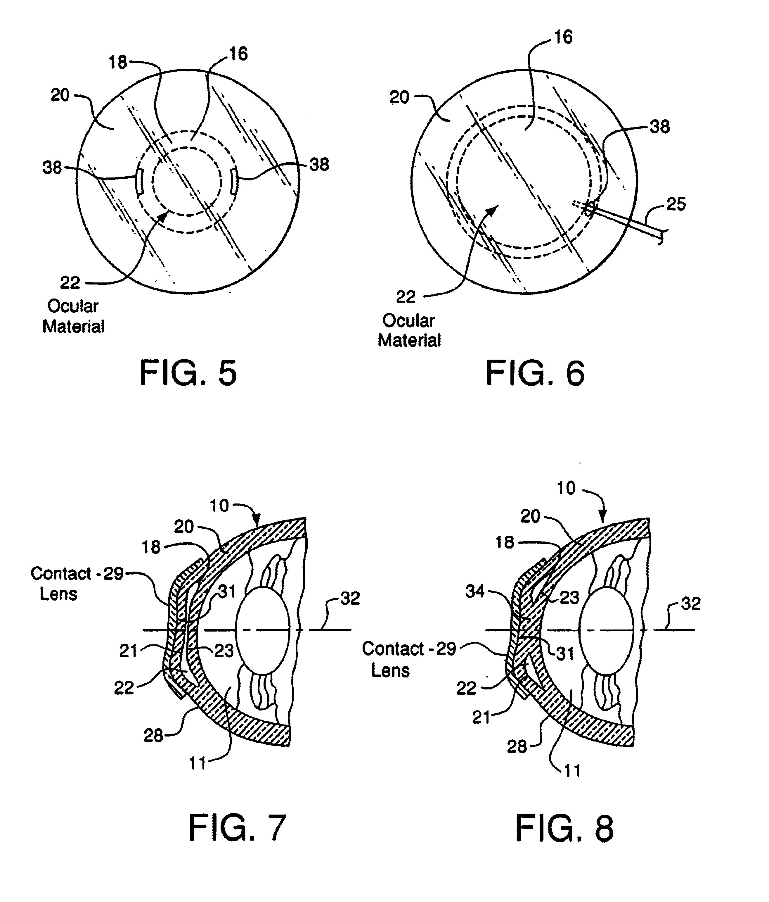 Adjustable ablatable inlay