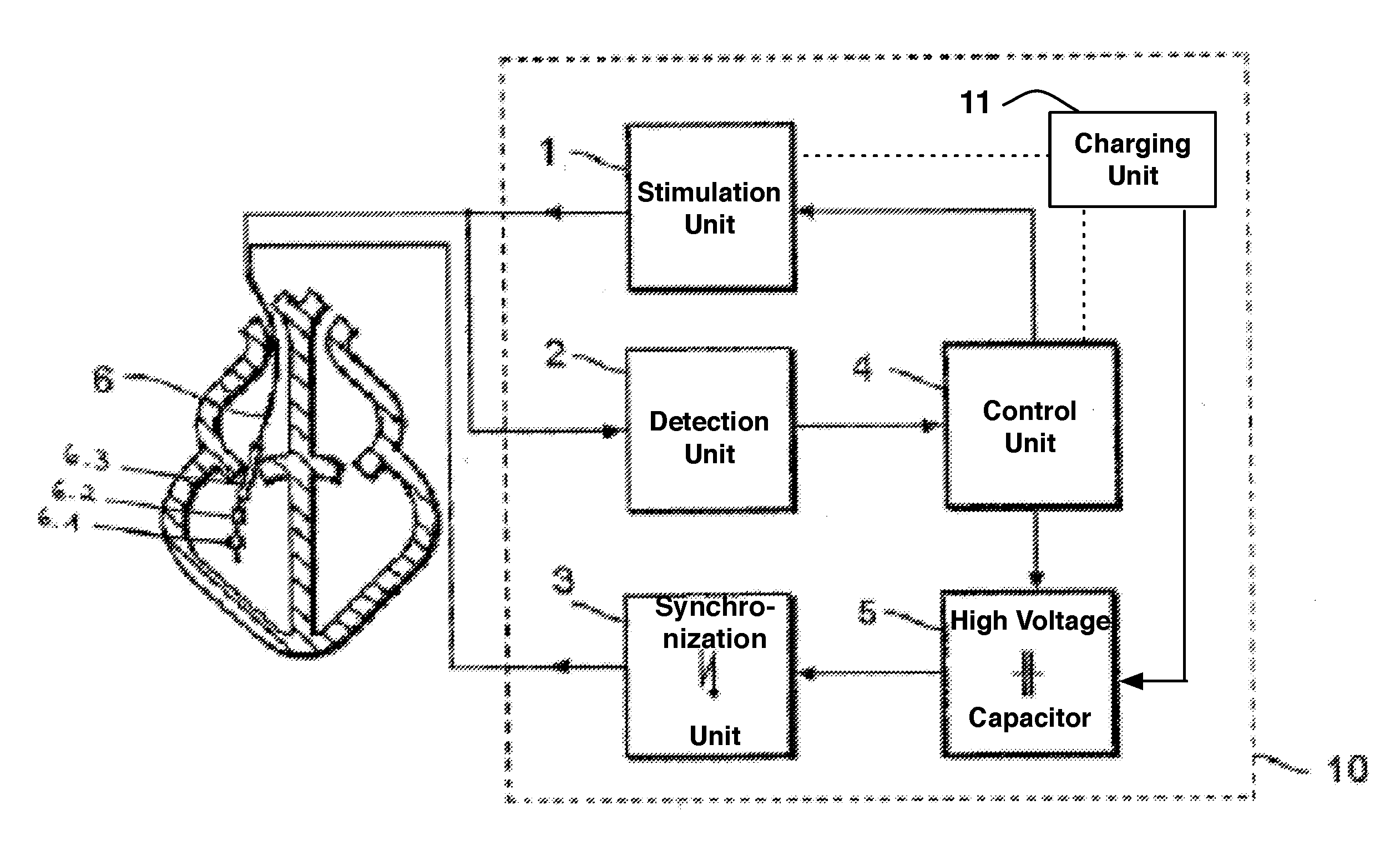 Implantable cardioverter-defibrillator including arrhythmia detection criteria