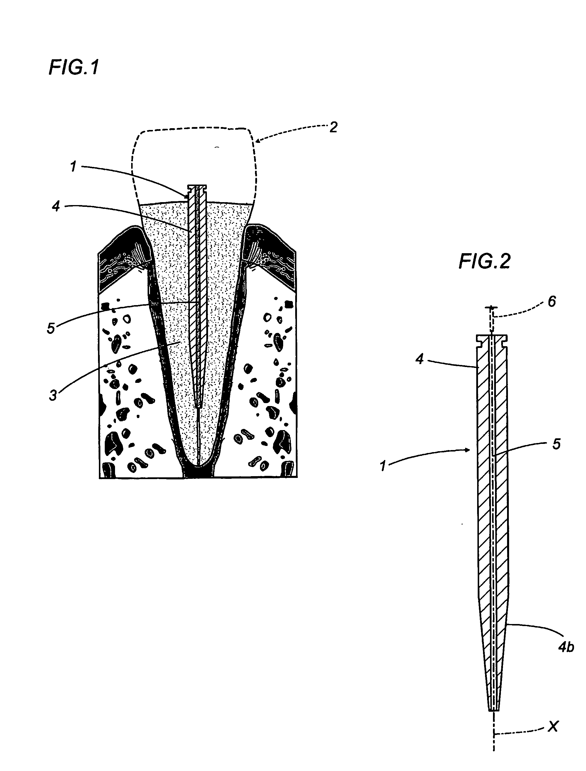 Supporting and strengthening element for dental prostheses or crown restorations