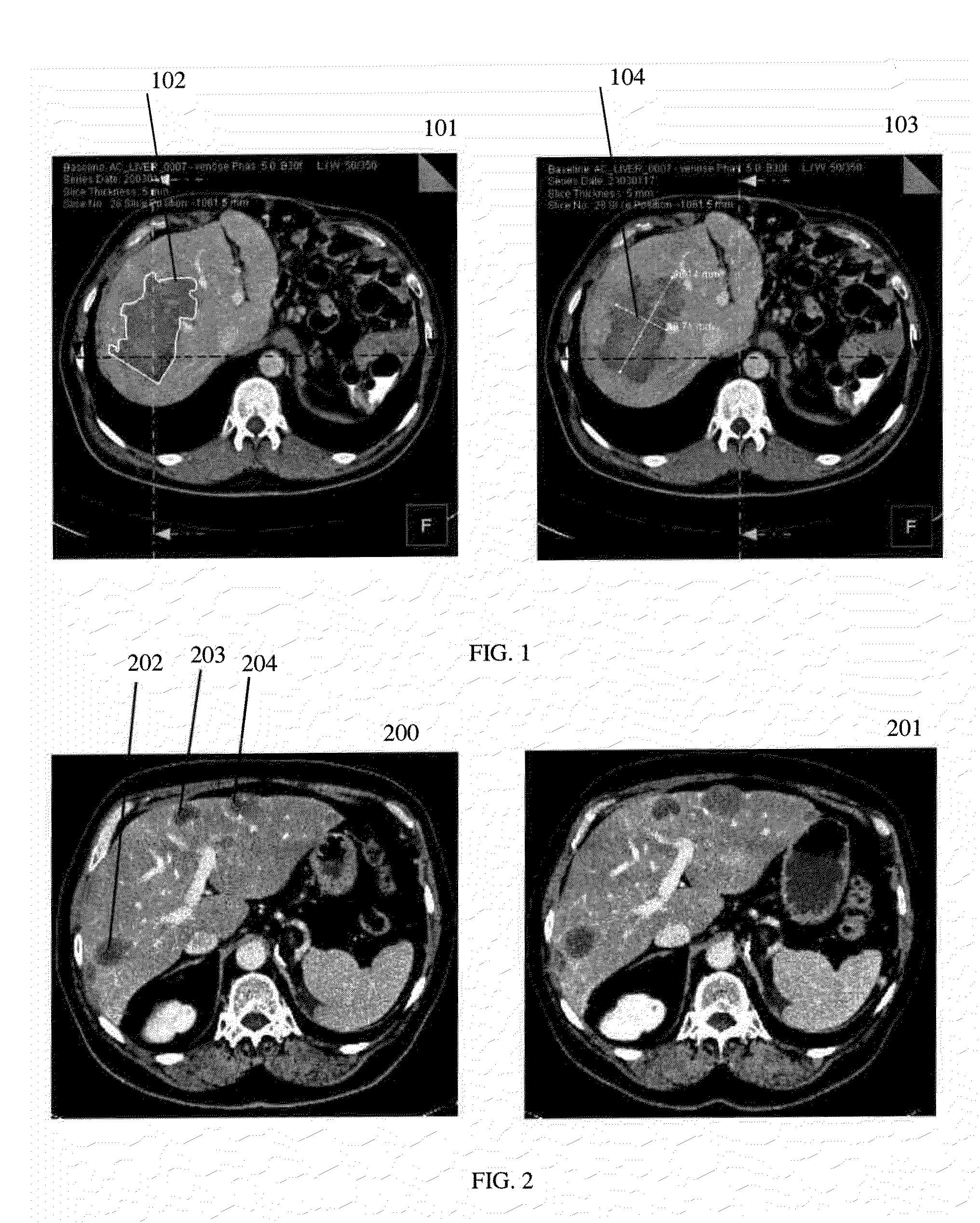 Combined segmentation and registration framework for parametric shapes