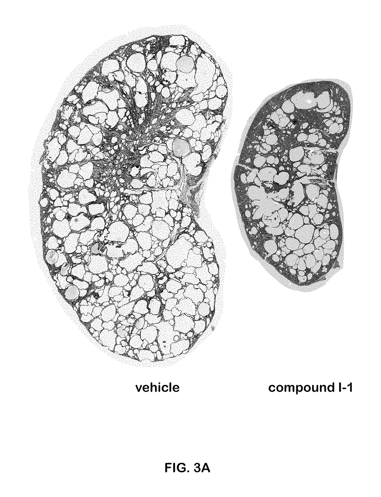 Methods for treating polycystic kidney disease and polycystic liver disease