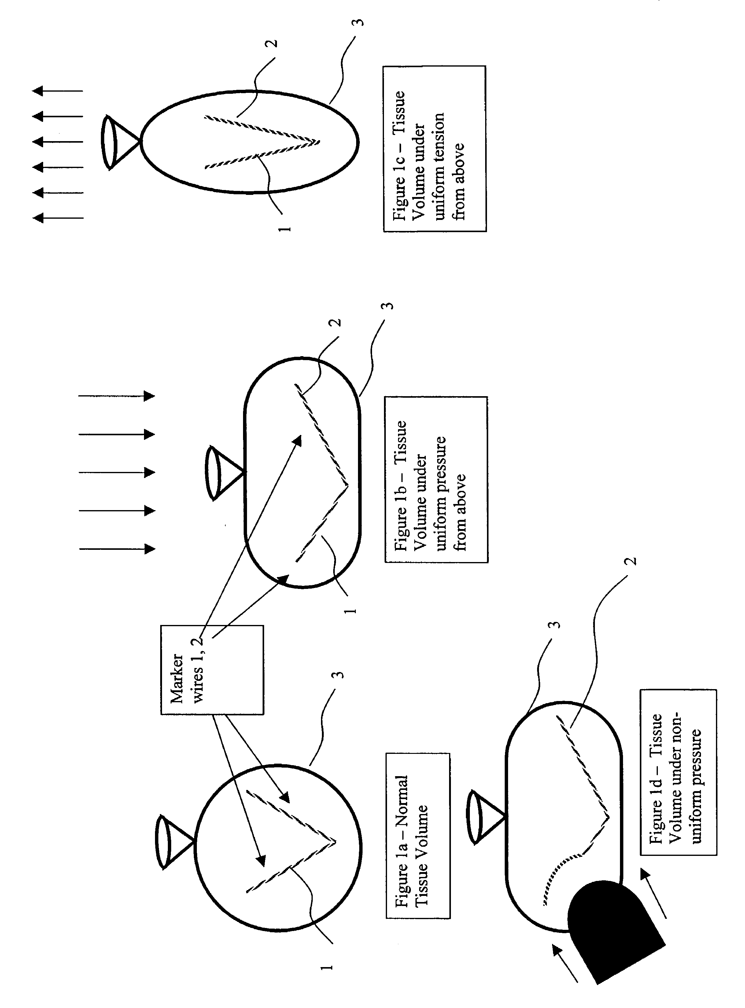 Elongated markers for soft tissue volume identification