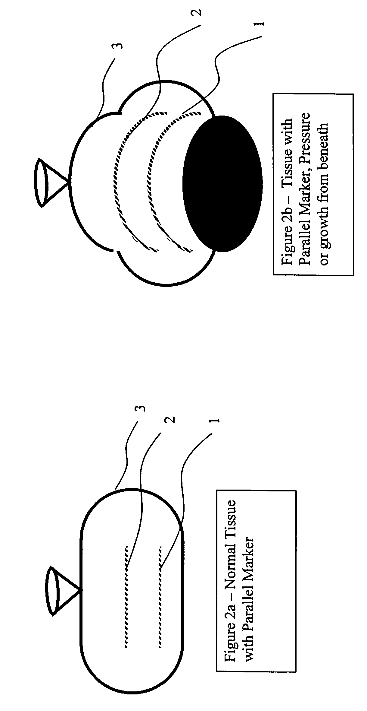 Elongated markers for soft tissue volume identification