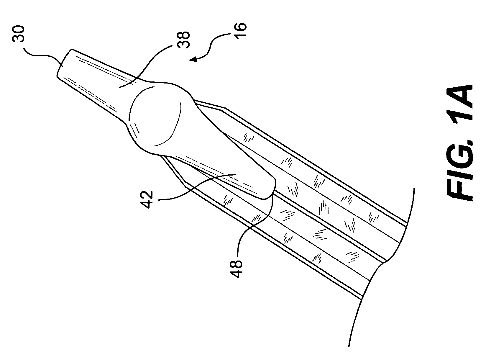 Stent