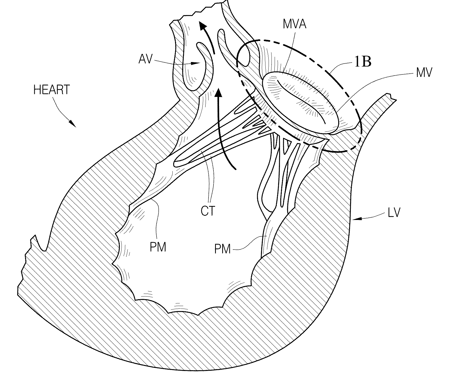 Valve replacement using rotational anchors