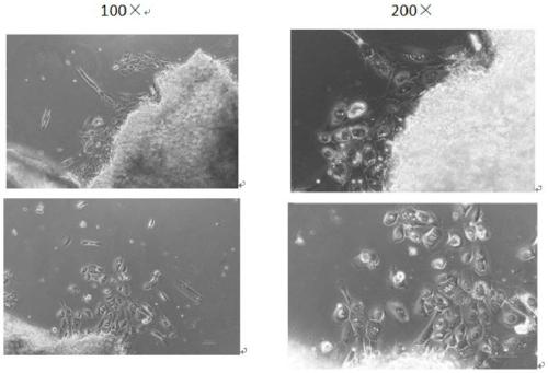 Humanized intestinal cancer precancerous lesion immortalized epithelial cell line and construction method and application thereof