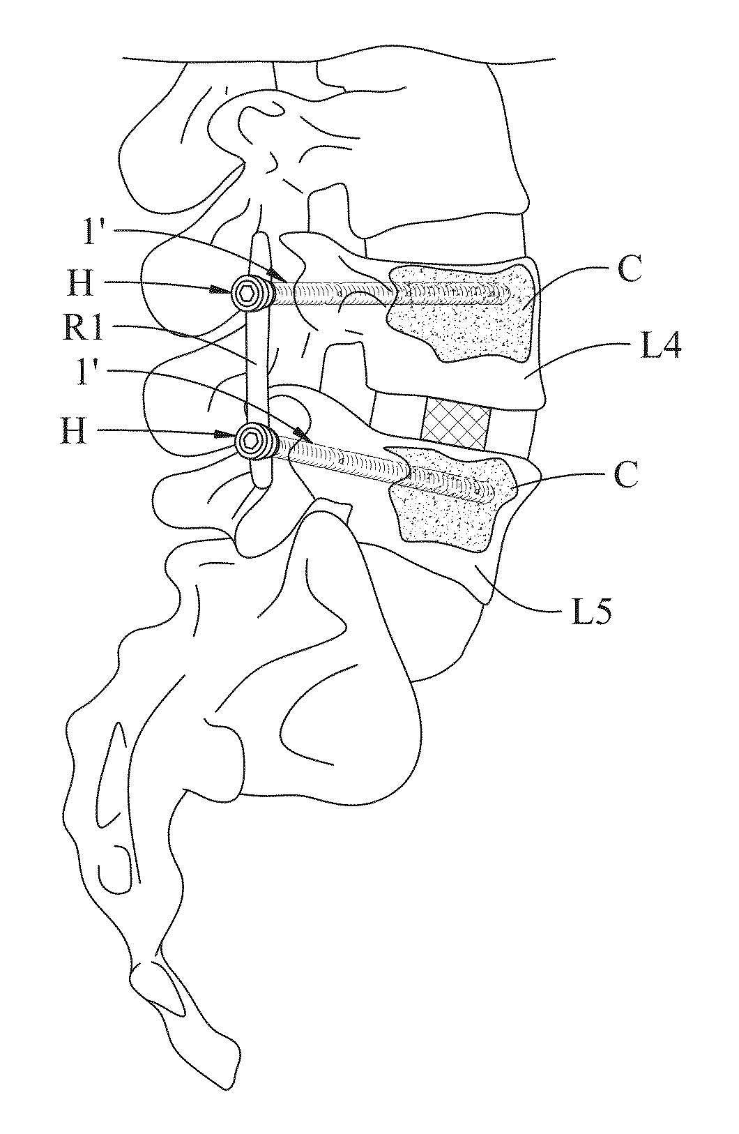 Fenestrated bone screw and method of injecting bone cement into bone structure