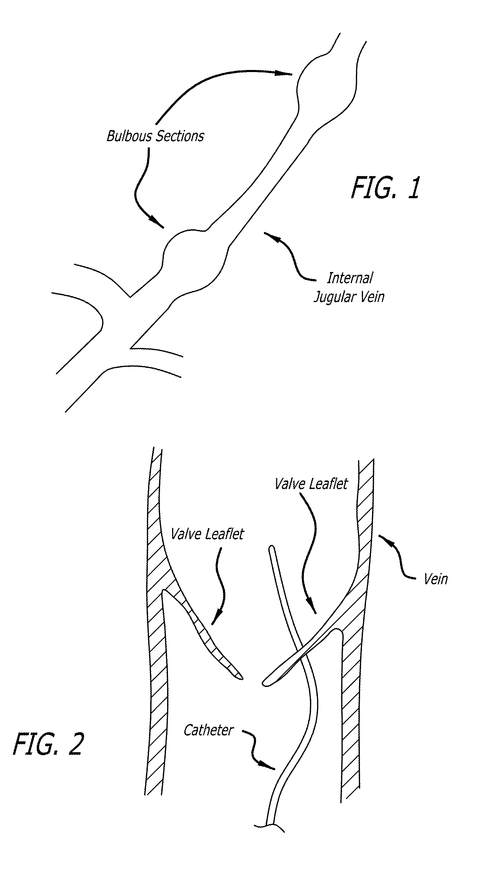 Method of delivering a medical device across a valve