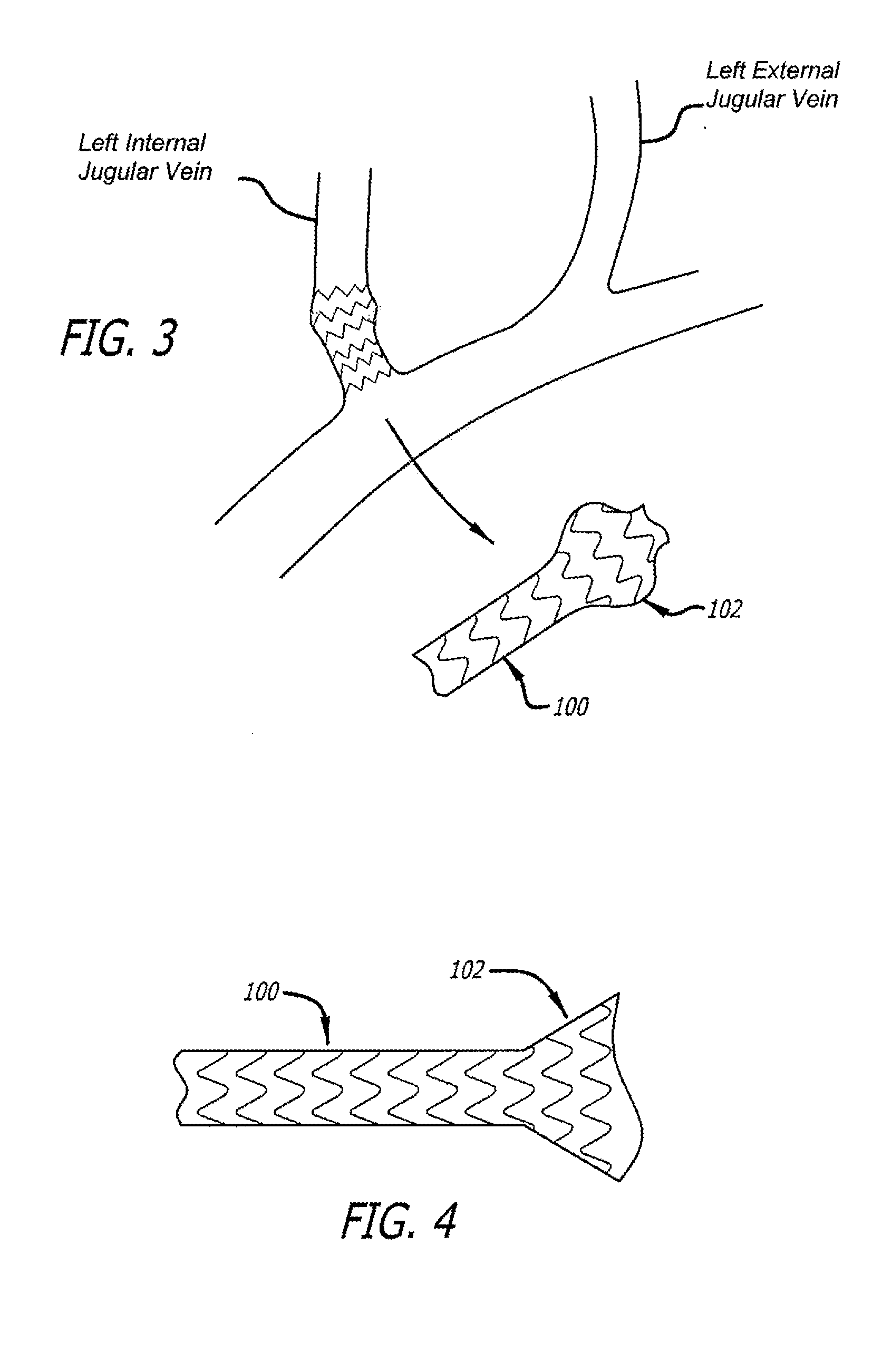 Method of delivering a medical device across a valve