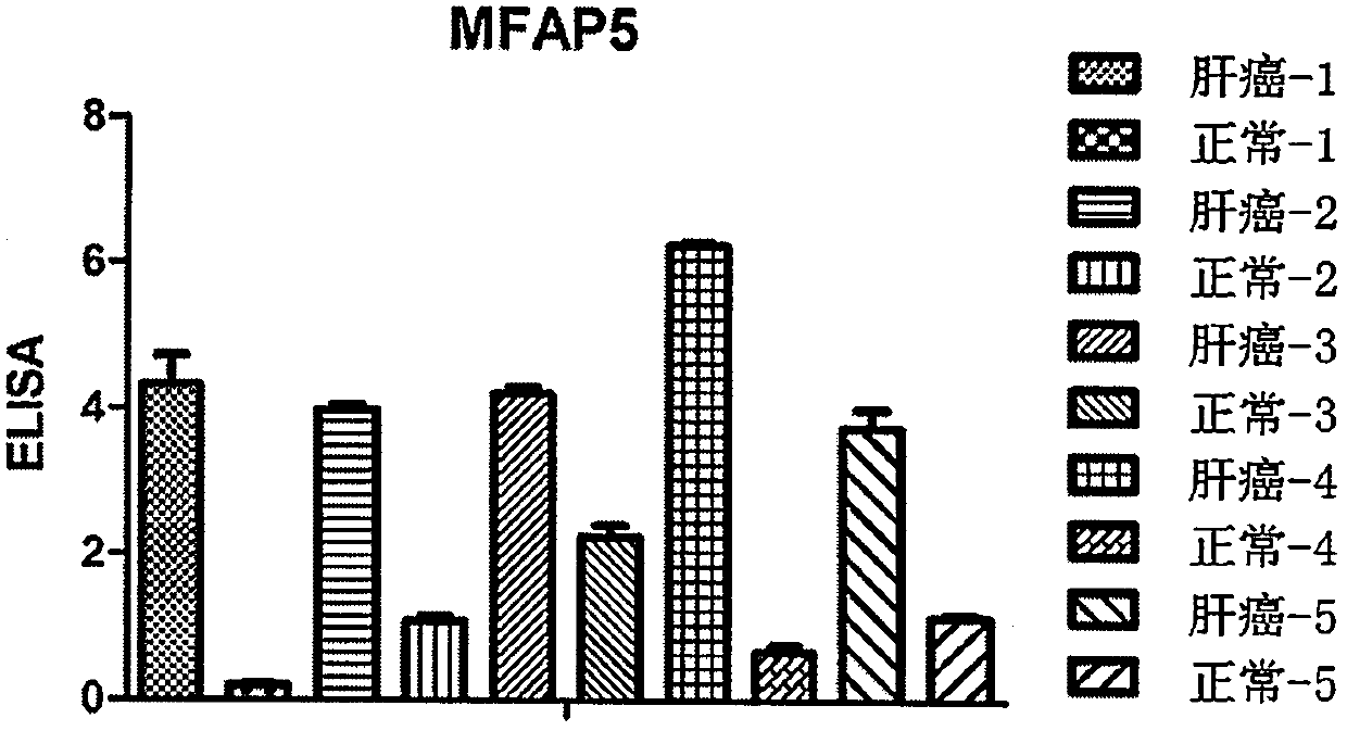 Application of MFAP5 in preparing preparation for screening markers of people sensitive to alpha interferon intervention in liver cancer