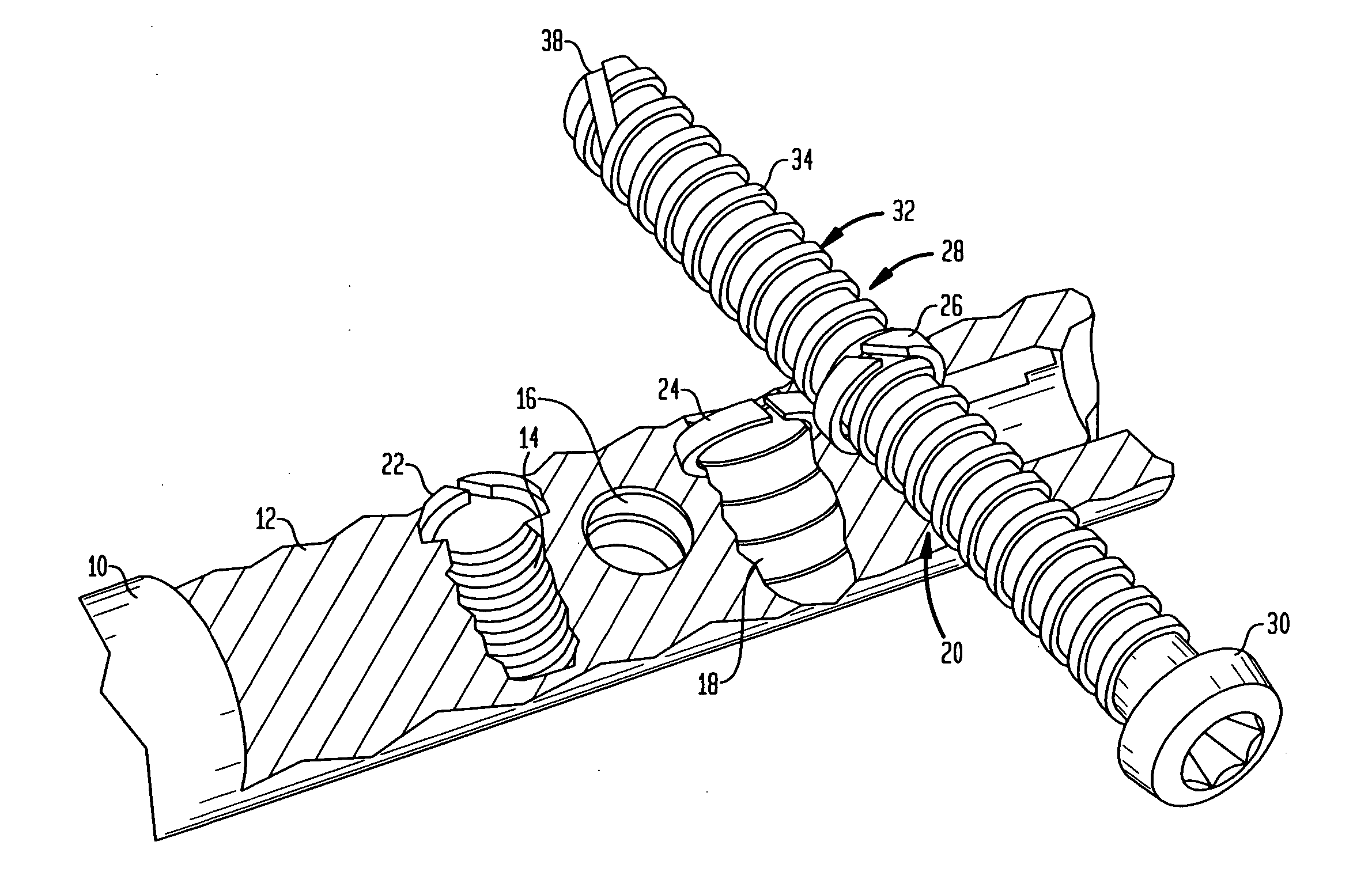 Implant for osteosynthesis